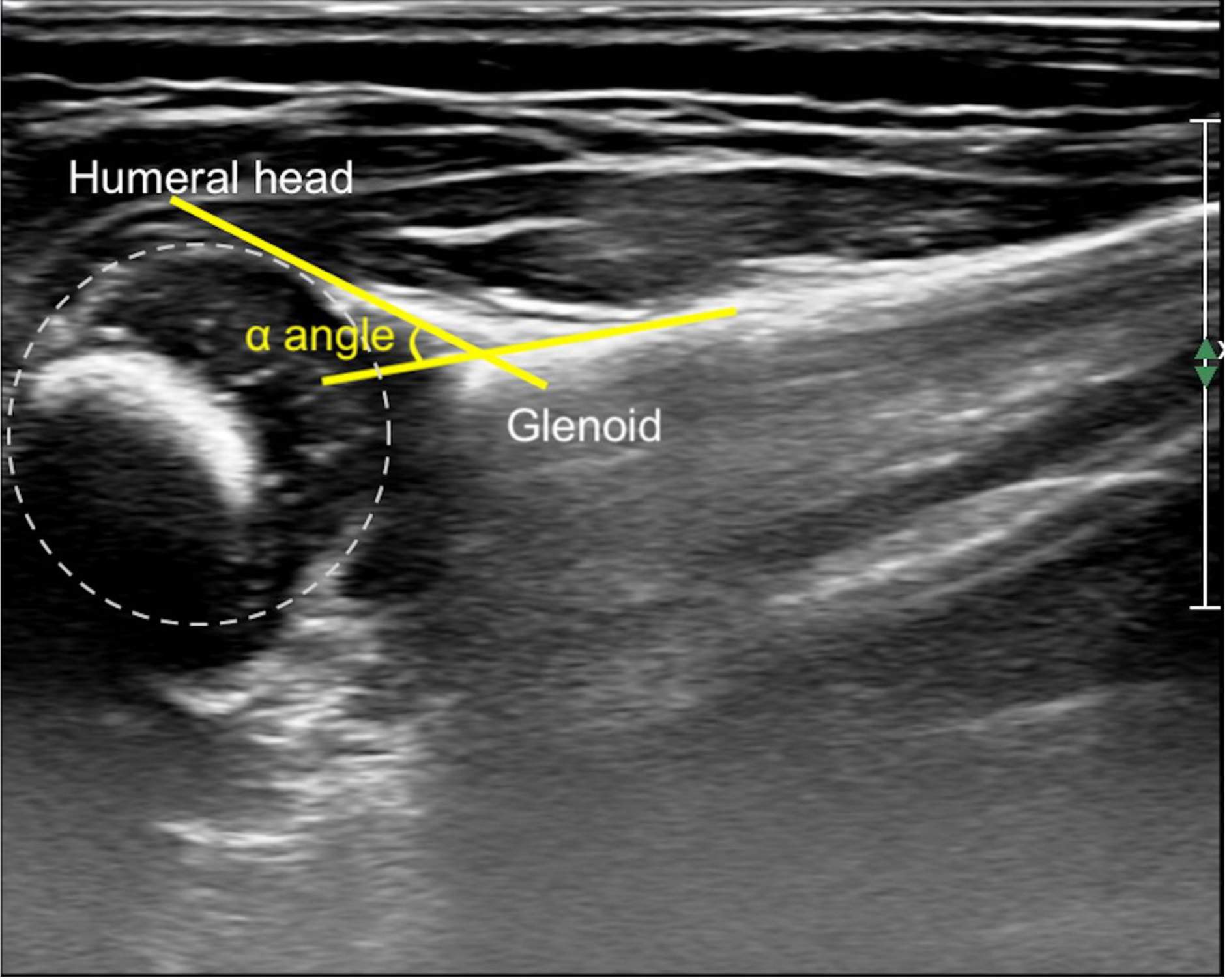 Ultrasound image of an affected shoulder of an infant with neonatal brachial plexus palsy. The α angle is determined by the meeting point of a line along the back edge of the shoulder blade and a tangent line from the rear of the glenoid labrum to the humeral head. A normal α angle is typically 30∘ or less.