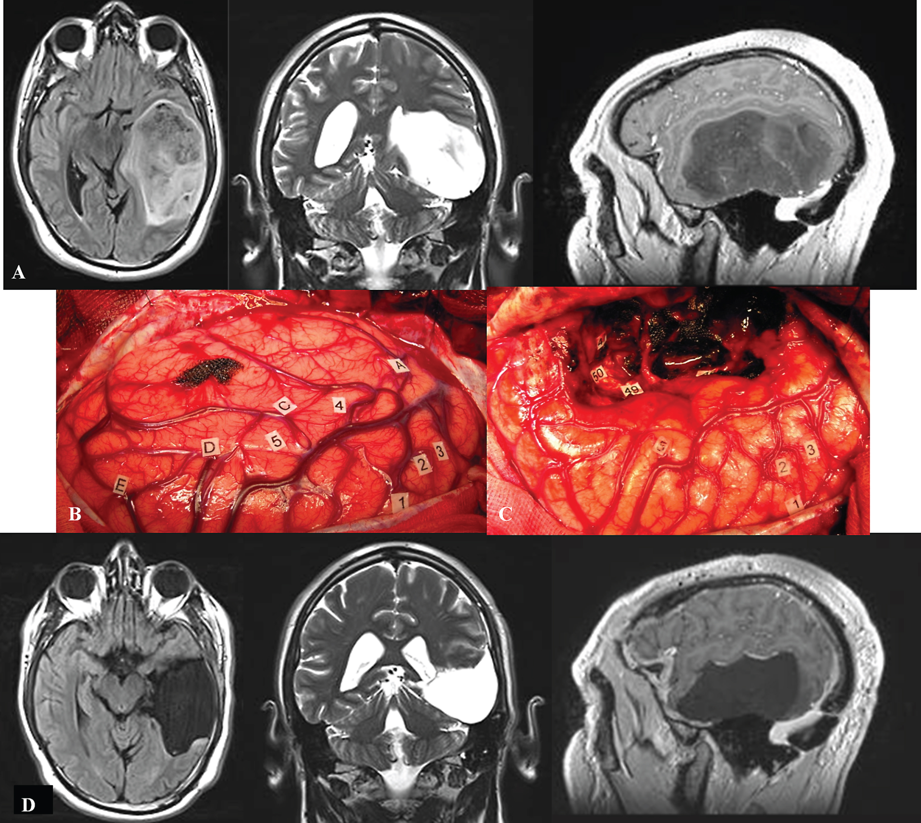 A. Preoperative axial FLAIR-weighted MRI, coronal T2-weighted MRI and sagittal enhanced T1-weighted MRI, in a 42 year-old right-handed male who presented with partial seizures and language disorders on presurgical cognitive examination, showing a voluminous glioma involving the left temporal lobe. B: Intraoperative view before resection. The anterior part of the left hemisphere is on the right and its posterior part is on the left. Letter tags correspond to the projection on the cortical surface of the tumor limits identified using ultrasonography. Number tags show zones of positive DES mapping as follows, 1, 2 and 3: ventral premotor cortex (generating anarthria during DES); 4 (mid-part of the superior temporal gyrus): areas involved in lexical access (eliciting anomia during DES); 5 (posterior part of the superior temporal gyrus): areas involved in semantic processing (inducing semantic paraphasia during DES). C: Intraoperative view after resection, achieved up to eloquent structures, both at cortical and subcortical levels. Indeed, DES of white matter tracts allowed the detection of the ventral stream underpinned by the IFOF (eliciting semantic paraphasias when stimulated, tag 46); the detection of the inferior longitudinal fascicle (anterior part of the posterior segment, generating reading disturbances during DES, tag 47); the optic radiations more deeply located (inducing transient visual disturbances when stimulated, tag 50); as well as the detection of the temporal part of the SLF subserving the dorsal stream (eliciting phonological disorders when stimulated, tag 49). D: Immediate axial FLAIR-weighted MRI, coronal T2-weighted MRI and sagittal enhanced T1-weighted MRI, showing a complete tumor removal. The patient benefited from a cognitive rehabilitation within the weeks following resection, and improved in comparison with the presurgical status, on the postsurgical language assessment achieved 3 months later. The diagnosis of low-grade glioma was confirmed, and no adjuvant oncological treatment was administrated. The patient resumed a normal familial, social and professional life within 3 months following surgery, with no functional deficits (no neurological and no cognitive disorders, no seizures) thanks to the preservation of the subcortical connectivity - despite an extensive resection of the temporal lobe in the left hemisphere.