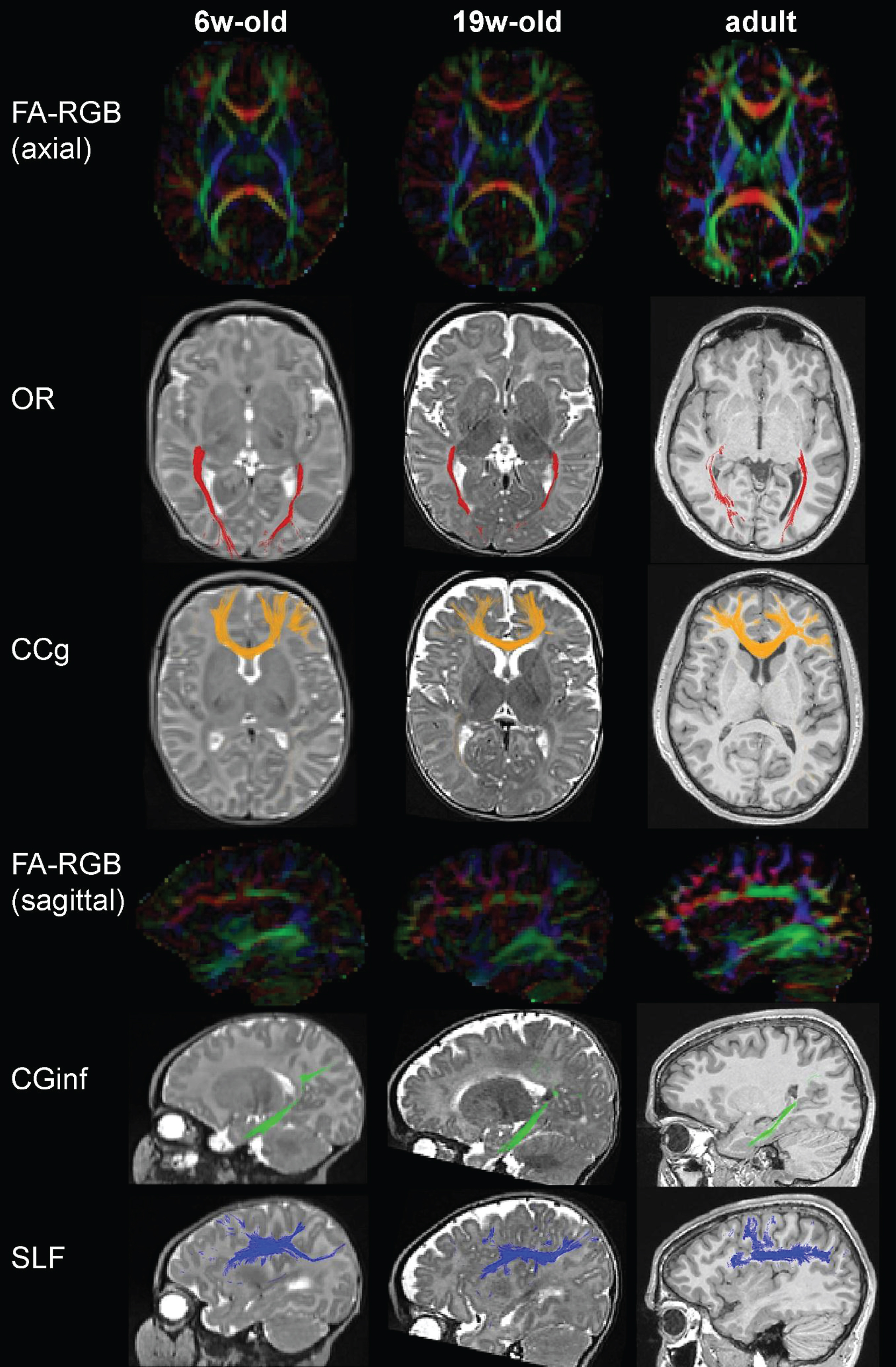 Main bundles assessed by tractography are similar in early life and adulthood. DTI color-coded directionality maps (FA-RGB) for two infants of different ages (6 and 19 weeks old) and a young adult, on axial and sagittal views, and tract reconstructions superposed to anatomical images (T2-weighted in infants, T1-weighted in adult) for four examples of bundles (projection: optic radiations OR, commissural: genu of the corpus callosum CCg, limbic: inferior branch of the cingulum CGinf, association: superior longitudinal fasciculus SLF). Other examples of tracts can be found in [7, 40, 43].