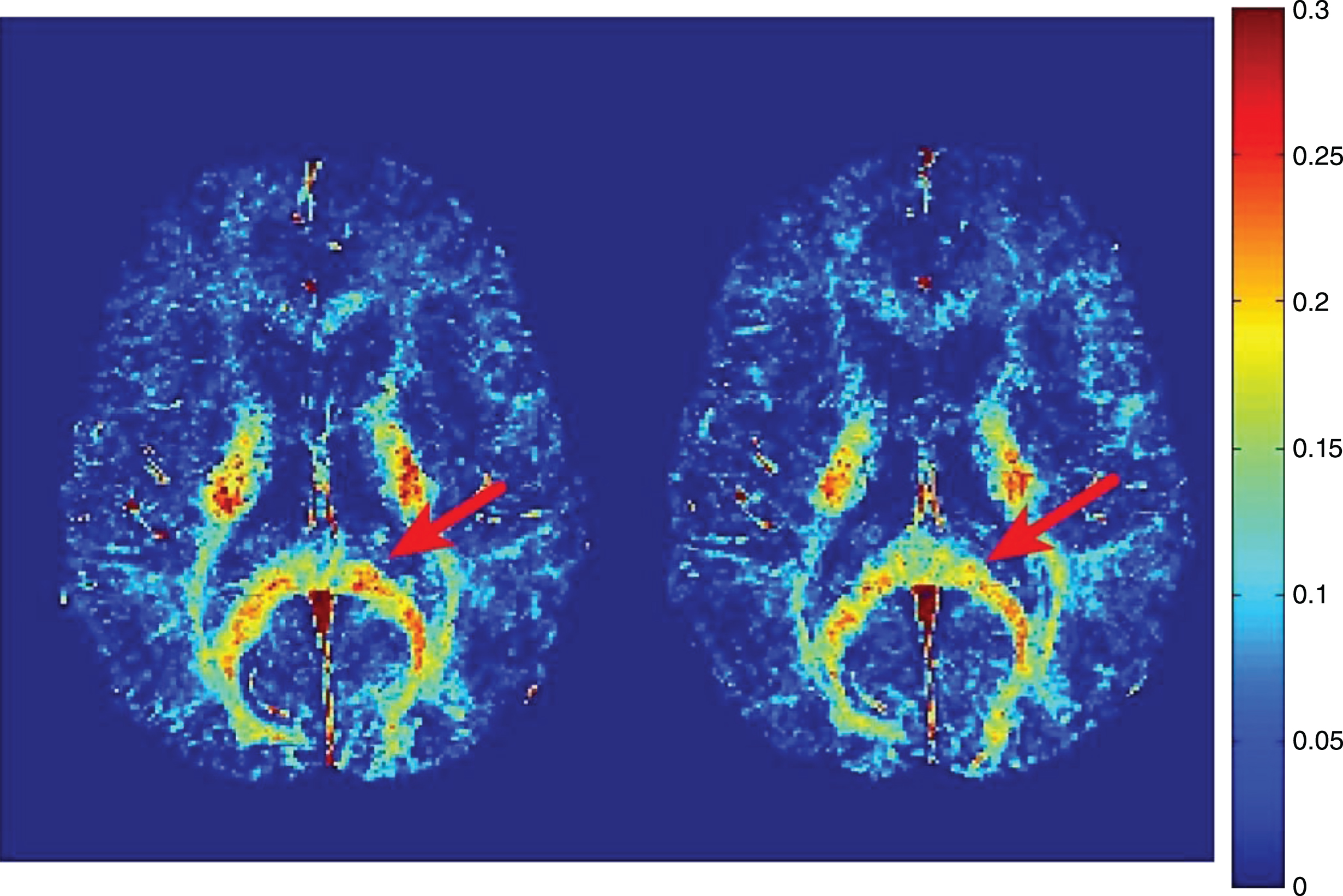 Representative myelin water fraction maps. Myelin water fraction maps from a concussed athlete at baseline (left) and two weeks post-injury (right). Myelin water fraction is measured as the T2-signal from 0–40ms divided by the total T2 signal. A region of the corpus callosum with visible reduction in MWF post-injury is highlighted by the red arrow (Fig. 1, Wright AD, Jarrett M, Vavasour I, Shahinfard E, Kolind S, van Donkelaar P, et al. Myelin Water Fraction Is Transiently Reduced after a Single Mild Traumatic Brain Injury - A Prospective Cohort Study in Collegiate Hockey Players. PLoS One. 2016;11(2):e0150215).