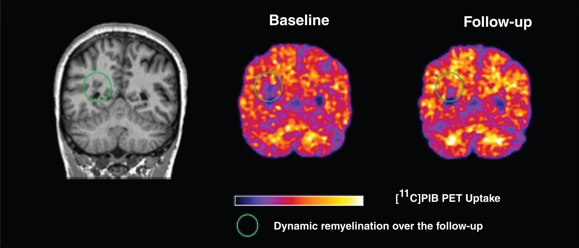 Imaging myelin dynamics by PET. Left, coronal view of the MPRAGE sequence acquired on a single representative patient with relapsing-remitting MS; Centre, the corresponding [11C]PIB PET at baseline; Right, the second PET time-point acquired 3 months later. Green circles indicate the evolution of single lesions visible as hypointense signals on MPRAGE scans, with a reduction in [11C]PIB uptake at baseline reflecting myelin loss, and a subsequent partial increase of the [11C]PIB signal at the second time-point, indicating possible dynamic remyelination.