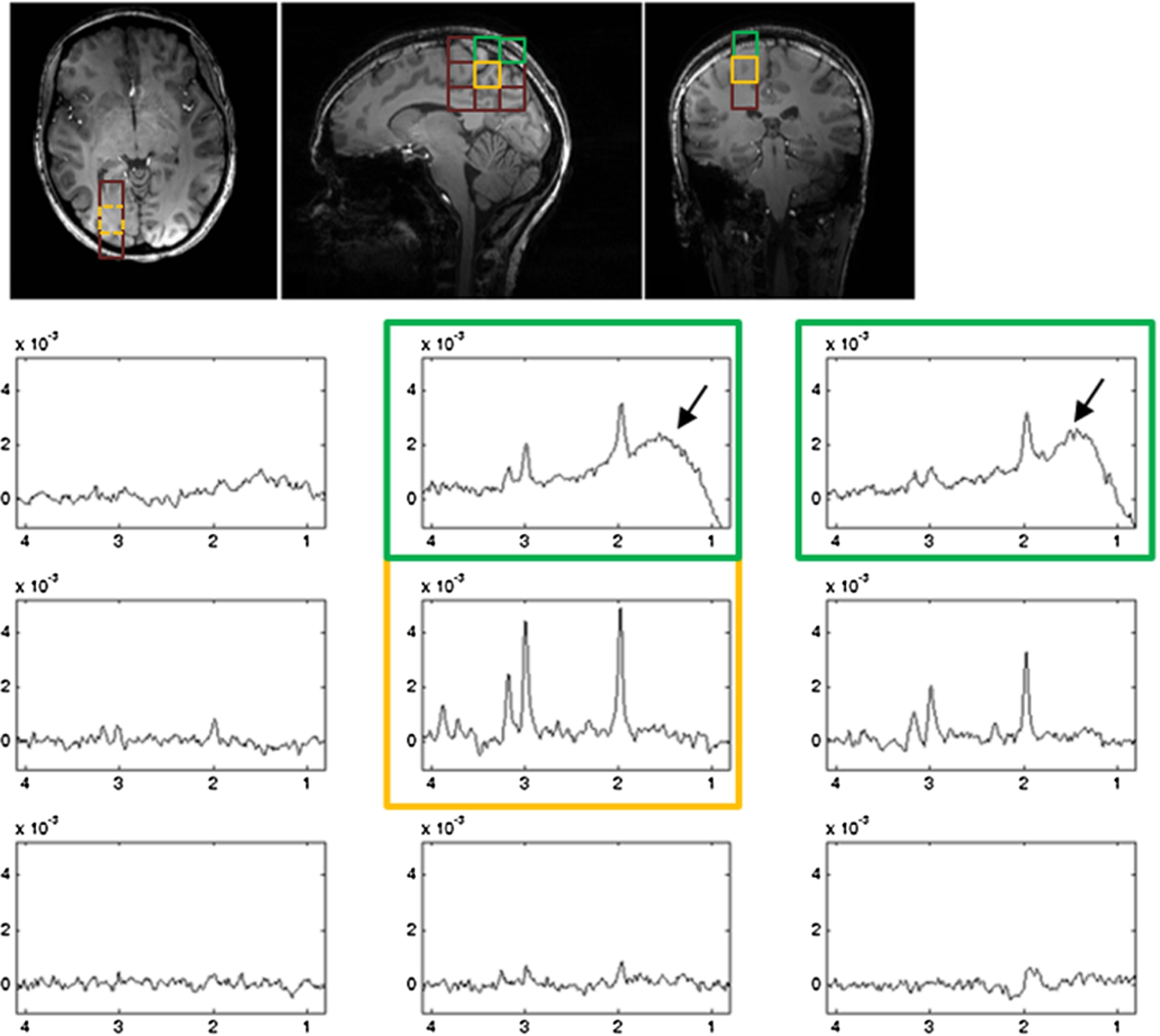 Examples of spatially arrayed spectra from Subject 1 (A) and Subject 5 (B). Different rows and columns correspond to different red grids overlaid on the T1-weighted image in Fig. 5. Spectra from VOI are marked by yellow squares. Black arrows indicate that lipid signals were found in spectra from some non-VOI voxels for subject 1 (A) and most of the non-VOI voxels for subject 5 (B).