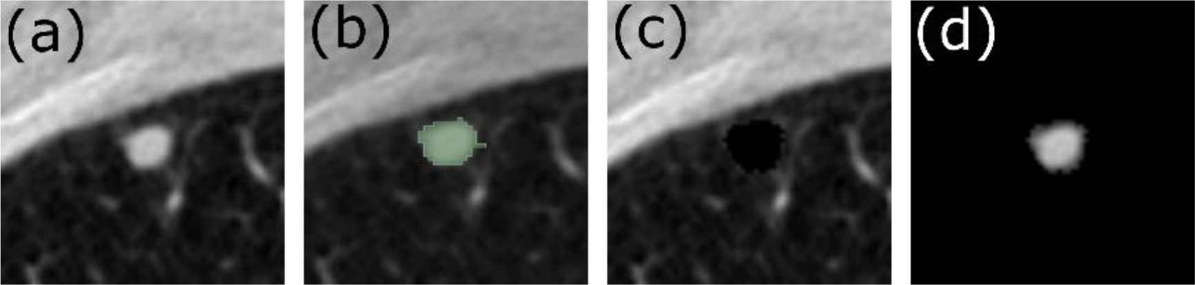 Axial slice from a Low Dose Computed Tomography (LDCT) image showing the (a) the original LDCT scan, (b) the segmented tumor map, (c) the parenchyma-only image, (d) the tumor-only image.