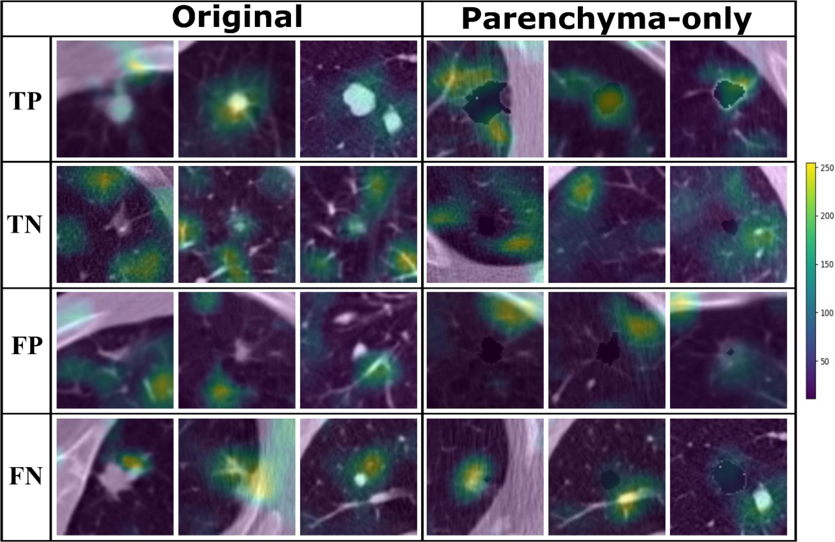 Grad-CAM images from the original dataset and parenchyma-only dataset showing network attention for malignant and benign nodules based on class label.