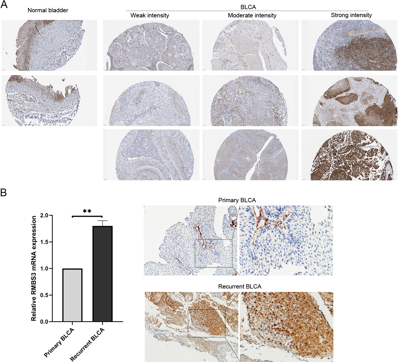 RBMS3 expression in BLCA tissue. (A)The immunohistochemistry results of RBMS3 protein in normal bladder and BLCA tissues from the Human Protein Atlas. (B) In the primary and recurrent BLCA tissues, RBMS3 mRNA level was examined by quantitative real-time PCR, ** P< 0.01 (left), RBMS3 protein was detected by immunohistochemistry assay.