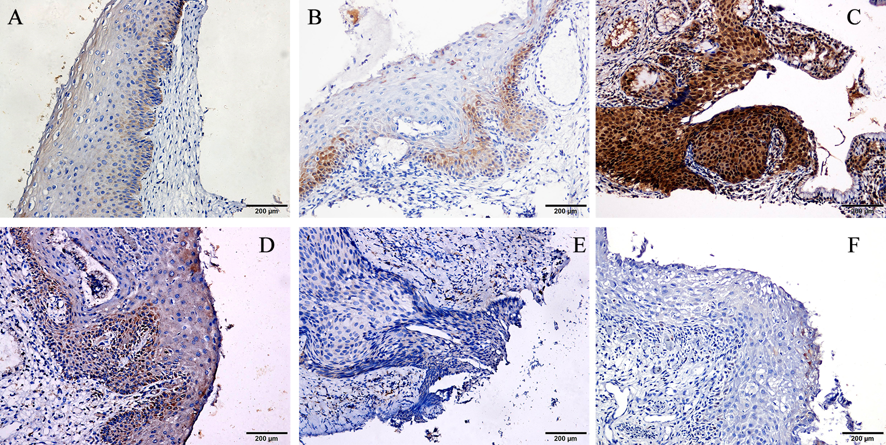 Representative images of immunohistochemistry (IHC) of cervical samples obtained from normal women and patients with cervical intraepithelial neoplasia (CIN). (A) FHIT expression in CIN3 tissue. (B) FHIT expression in CIN1tissue. (C) FHIT expression in normal tissue. (D) C-MYC expression in CIN3 tissue. (E) C-MYC expression in CIN1 tissue. (F) C-MYC expression in normal tissue. Original magnification × 200.