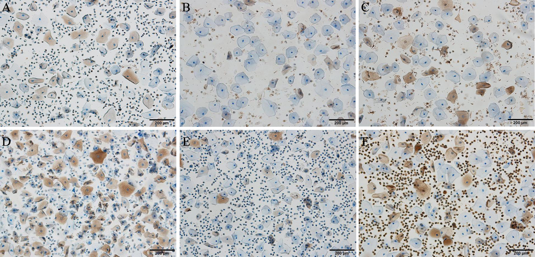 Representative images of ICC in cervical exfoliated cells obtained from normal women and patients with cervical intraepithelial neoplasia (CIN). (A) FHIT expression in exfoliated cells obtained from normal tissue. (B) FHIT expression in exfoliated cells obtained from CIN1 tissue. (C) FHIT expression in exfoliated cells obtained from CIN3 tissue. (D) C-MYC expression in exfoliated cells obtained from normal tissue. (E) C-MYC expression in exfoliated cells obtained from CIN1 tissue. (F) C-MYC expression in exfoliated cells obtained from CIN3 tissue. Original magnification × 400.