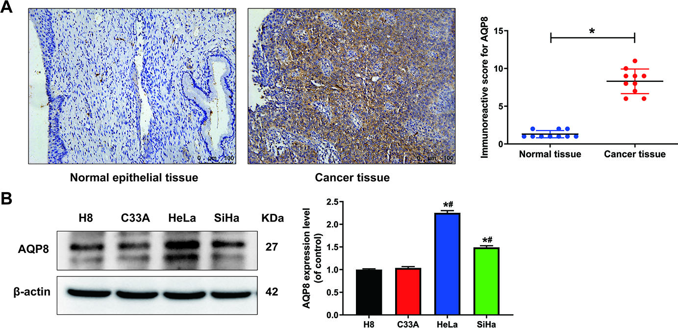 The expression of AQP8 in human cervical cancer tissues and cell lines. A, Immunohistochemistry analysis showed a strong positive staining of AQP8 protein in cervical cancer samples but negative in adjacent normal cervix (magnification, 200 ×). The data shown were the IHC scores of the AQP8 and the means ± standard error between cervical cancer and normal cervical tissues. P*< 0.05 vs normal cervical tissue group; B, The expression of AQP8 protein in normal cervical epithelial cell lines (H8) and cervical cancer cell lines (C33A, HeLa and SiHa) was detected using western blot analysis. The data shown were the ratios of the AQP8/β-actin and the means ± standard error of each cell lines. Each experiment was performed three times. P*< 0.05 vs H8 group; P#< 0.05 vs C33A group.