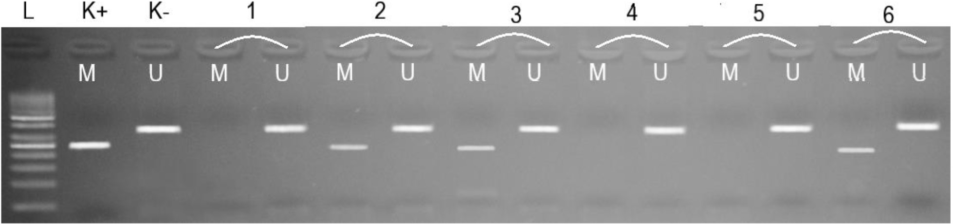 Electrophoregram of methylated (M) and unmethylated (U) DNA amplification products in the promoter region of the BRCA2 gene. L – 50-bp DNA ladder; K+ – methylated control fragment; K- – unmethylated control fragment; Samples 1, 4, 5 – UU; Samples 2, 3, 6 – MU.