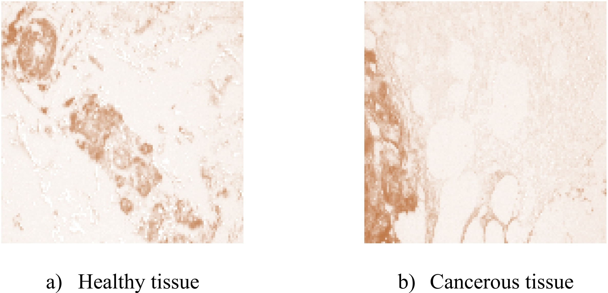 Samples of the Biglycan biomarker images for healthy and cancerous tissues [27].