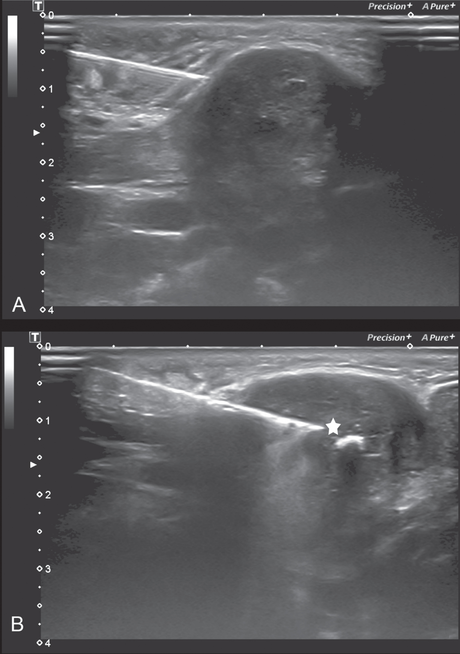 US-CNB is performed in B-Mode Sonography and the local anaesthesia is placed first (A) in the sample surrounding as well as (sub-)cutaneous before the 10-cm-long 16-G needle of the reusable gun corebiopsy system is put into the target (B); the tip of the needle is marked witha white star (*).