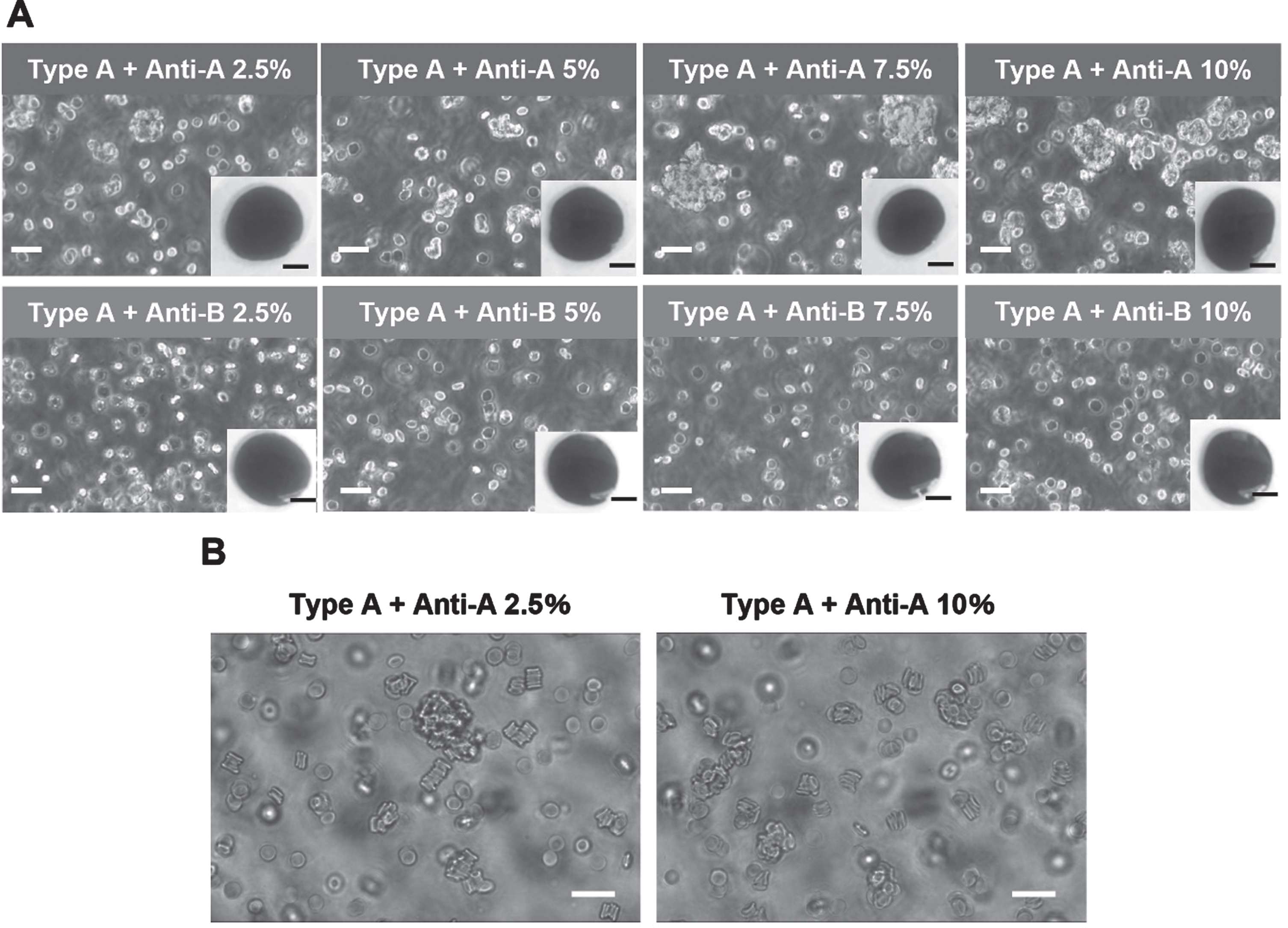 Microscope images of a representative sample mixed with antibody reagent. (A) Microscope images of samples diluted with saline at antibody reagent volume ratios of 2.5%, 5.0%, 7.5%, and 10% (scale bar: 20μm). The inset at the lower right of each panel shows a representative drop of sample before dilution with saline (scale bar: 5 mm). (B) Microscope images of type A blood diluted with autologous plasma at antibody reagent volume ratios of 2.5% and 10% (scale bar: 20μm).
