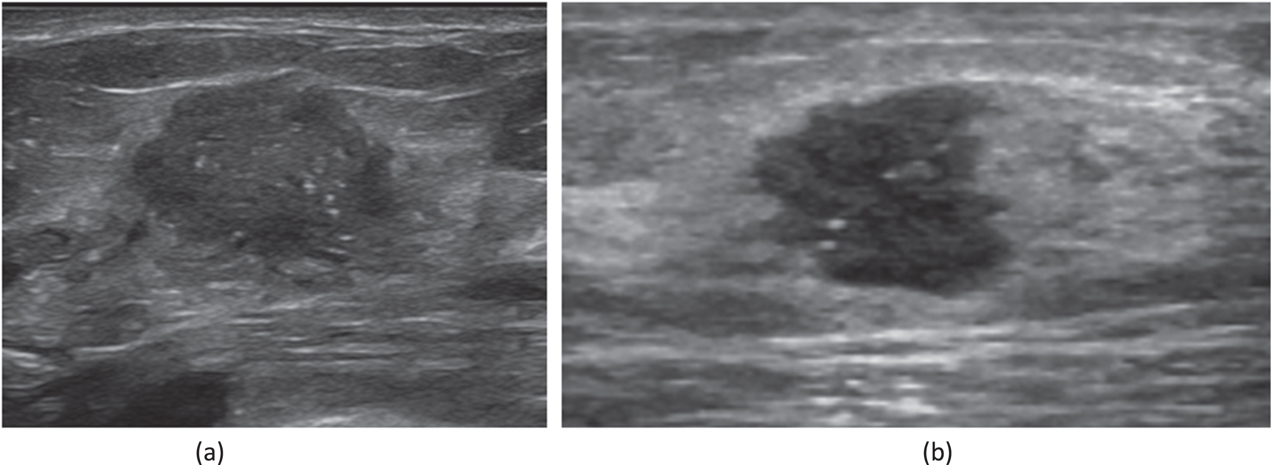 (a) A 45-year-old female patient who had been diagnosed with an invasive carcinoma in the left breast. Ultrasound of left breast showing a hypoechoic nodule with a maximum diameter of 20 mm with ill defined margins, Internal microcalcifications are seen within the nodule. The patient had left axillary lymph node metastasis. Immunohistochemistry showed that ER(+80%), PR(+80%), AR(+80%), HER2(2+), CK5/6(-), P53(+30%), Ki67(+30%). FISH showed that amplification of the HER-2 gene was negative. (b) A 59-year-old female patient who had been diagnosed with a non-special invasive carcinoma grade II in the left breast. Ultrasound of left breast showing a hypoechoic nodule with a maximum diameter of 12 mm with ill defined margins, Internal microcalcifications are seen within the nodule. The patient had left axillary lymph node metastasis. Immunohistochemistry showed that ER(+90%), PR(+10%), HER2(1+), CK5/6(-), P53(+5%), AR(+20%), Ki67(+30%).