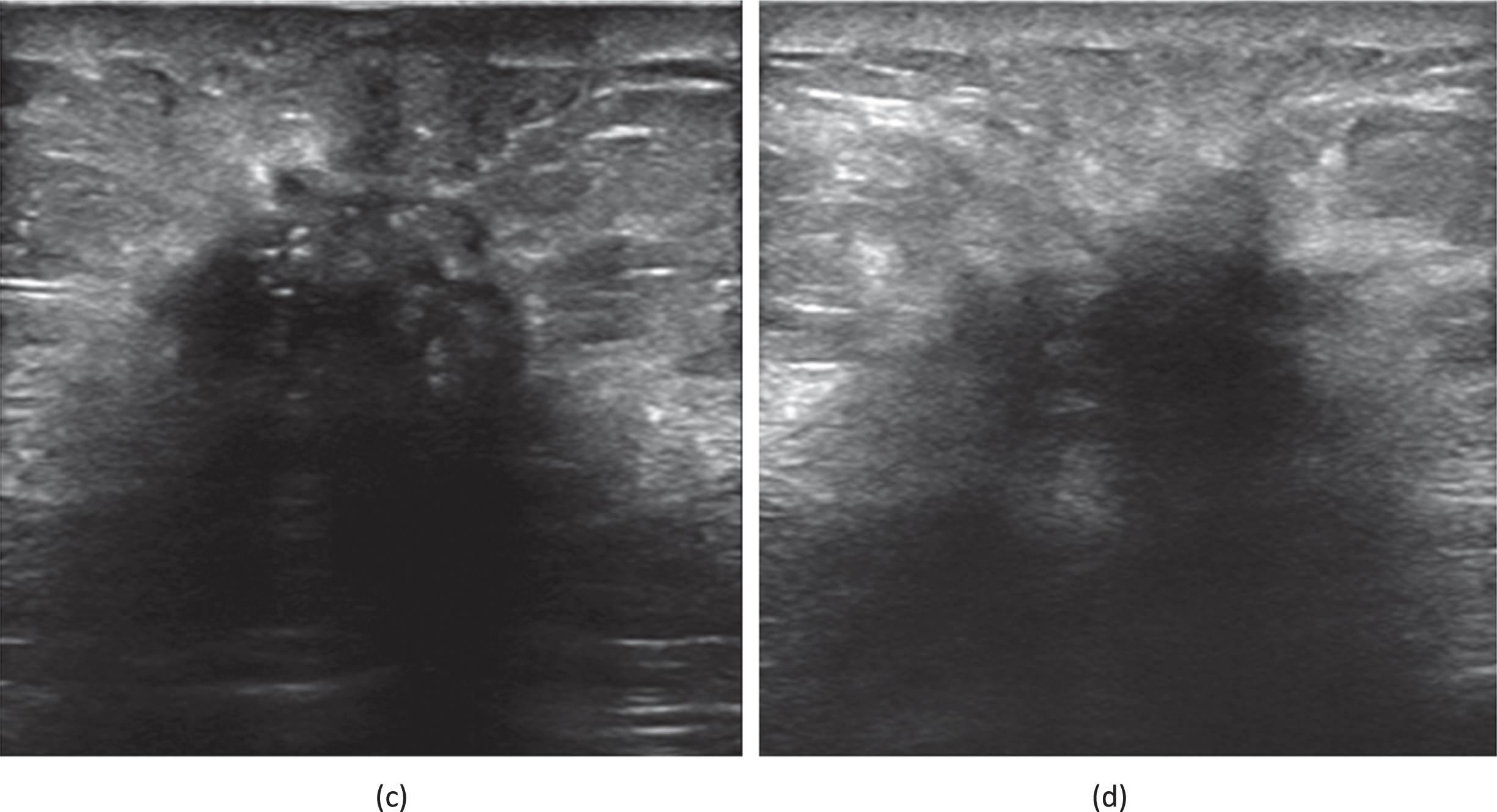 (c) A 69-year-old female patient who had been diagnosed with an invasive carcinoma in the left breast. Ultrasound of left breast showing a hypoechoic nodule with a maximum diameter of 17 mm with ill defined margins, ultrasound attenuation in the posterior fields are seen within the nodule. The patient had left axillary lymph node metastasis. (d) A 66-year-old female patient who had been diagnosed with a non-special invasive carcinoma grade II in the left breast. Ultrasound of left breast showing a hypoechoic nodule with a maximum diameter of 28 mm with ill defined margins, ultrasound attenuation in the posterior fields are seen within the nodule. The patient had left axillary lymph node metastasis. Immunohistochemistry showed that ER(+80%), PR(+20%), HER2(0), KI67(+20%).