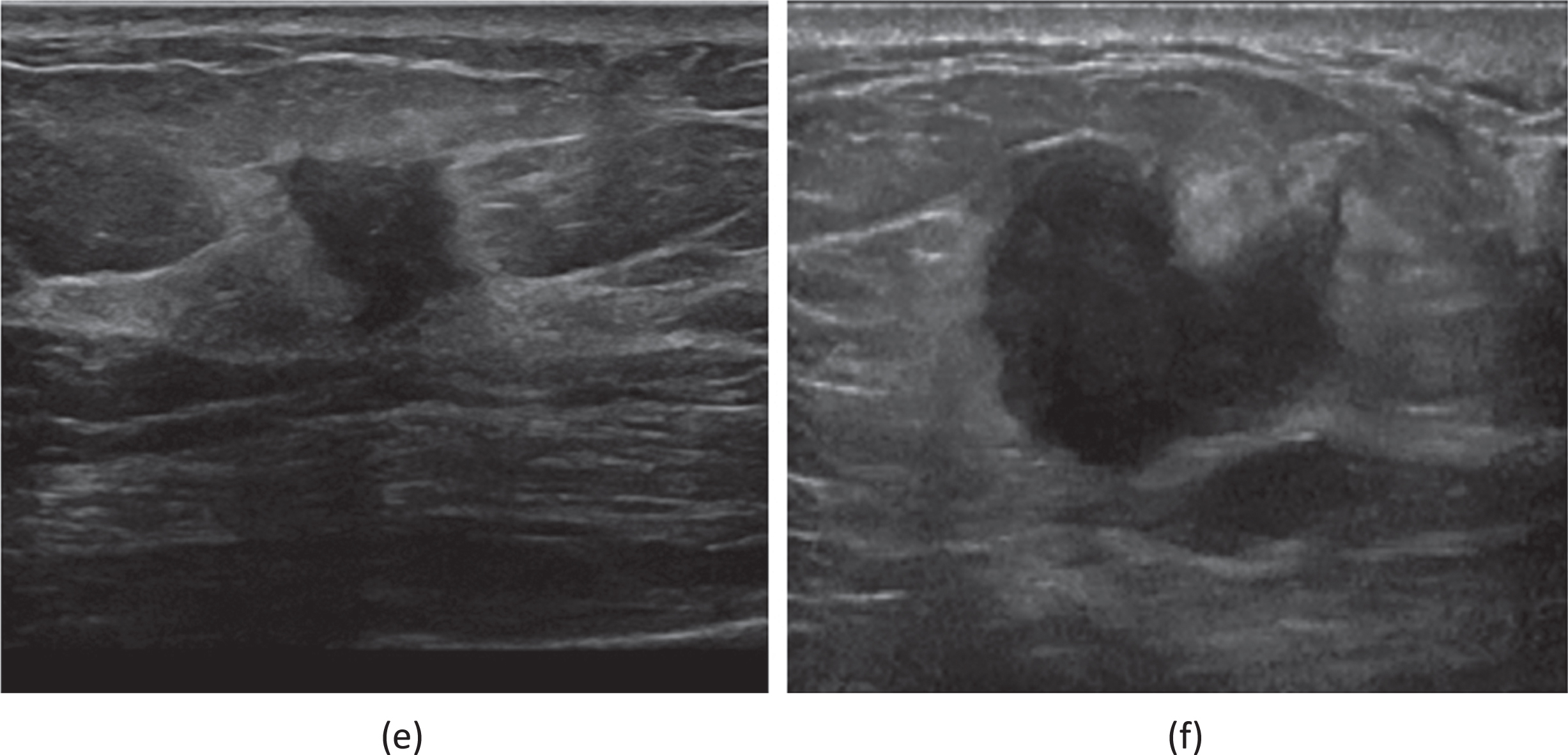 (e) A 59-year-old female patient who had been diagnosed with an invasive carcinoma in the right breast. Ultrasound of right breast showing a hypoechoic nodule with a maximum diameter of 20 mm with ill defined margins, hyperechoic halo are seen within the nodule. The patient had right axillary lymph node metastasis. Immunohistochemistry showed that ER(+80%), PR(+5%), HER2(1+), CK5/6(-), P53(+80%), Ki67(+40%), AR(+10%). (f) A 62-year-old female patient who had been diagnosed a non-special invasive carcinoma grade II in the right breast. Ultrasound of right breast showing a hypoechoic nodule with a maximum diameter of 16 mm with ill defined margins, hyperechoic halo are seen within the nodule. The patient had right axillary lymph node metastasis. Immunohistochemistry showed that ER(+80%), PR(-),Her-2(0), Ki67(+50%).