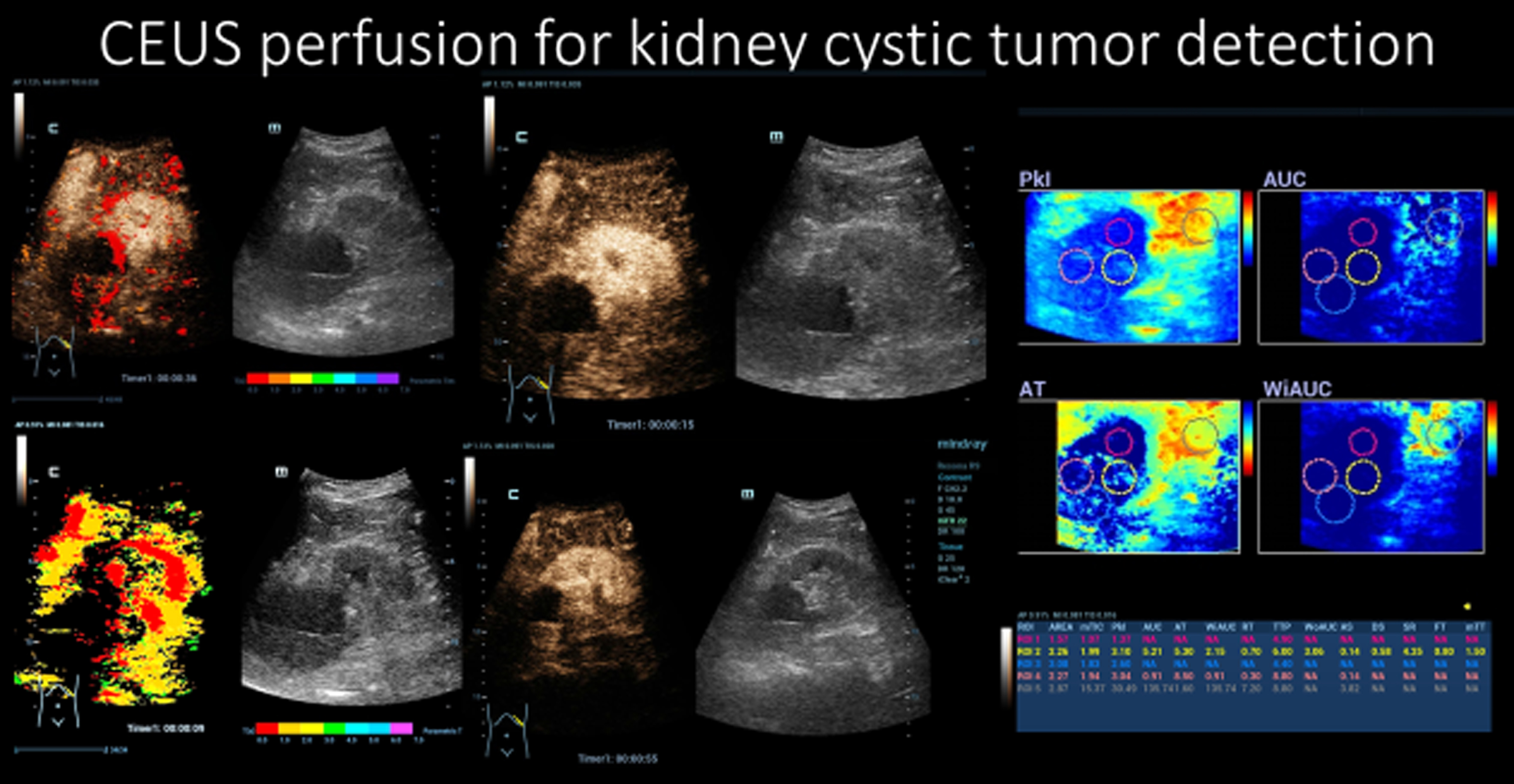 CEUS perfusion for the detection of a small intracystic kidney tumor.