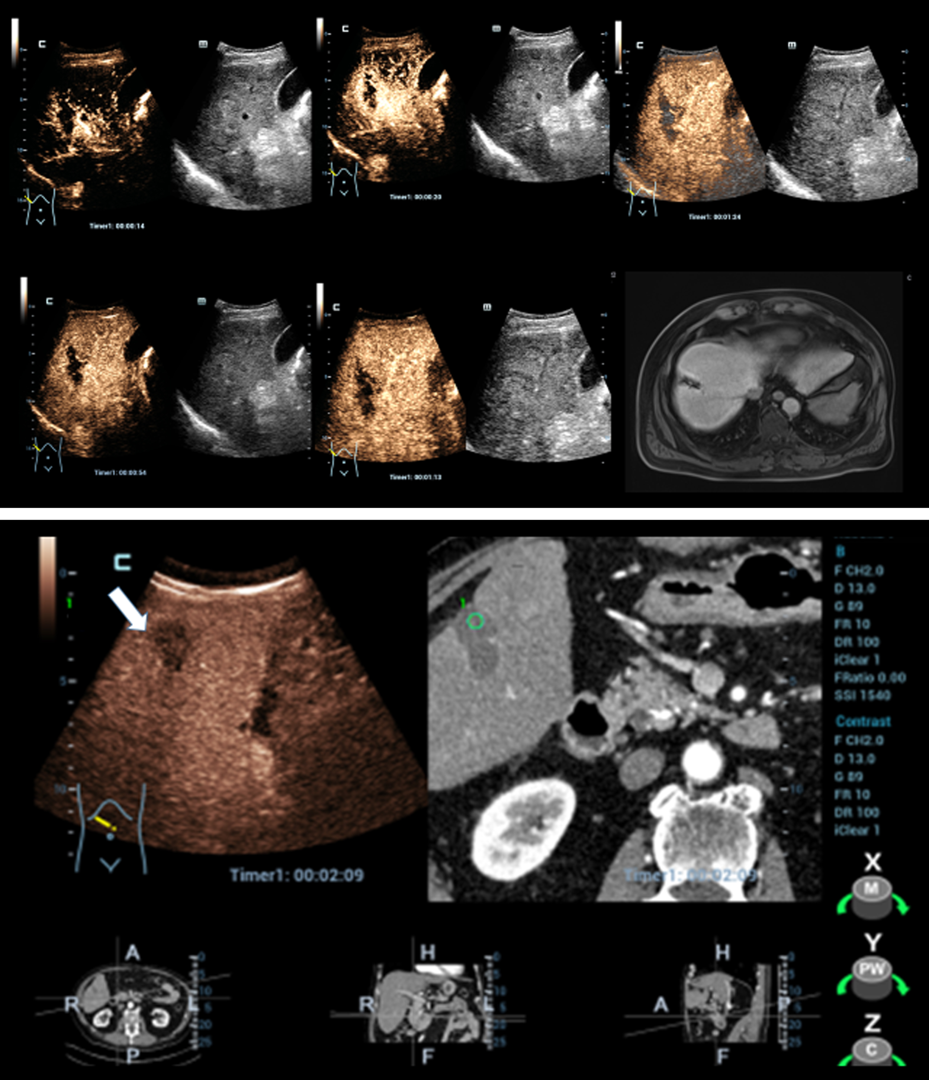 a/b: Dynamic CEUS using HiFR mode in correlation to contrast-enhanced MRI and fusion CEUS with contrast-enhanced CT to control successful microwave ablation (MWA) of a liver tumor with complete devascularization.
