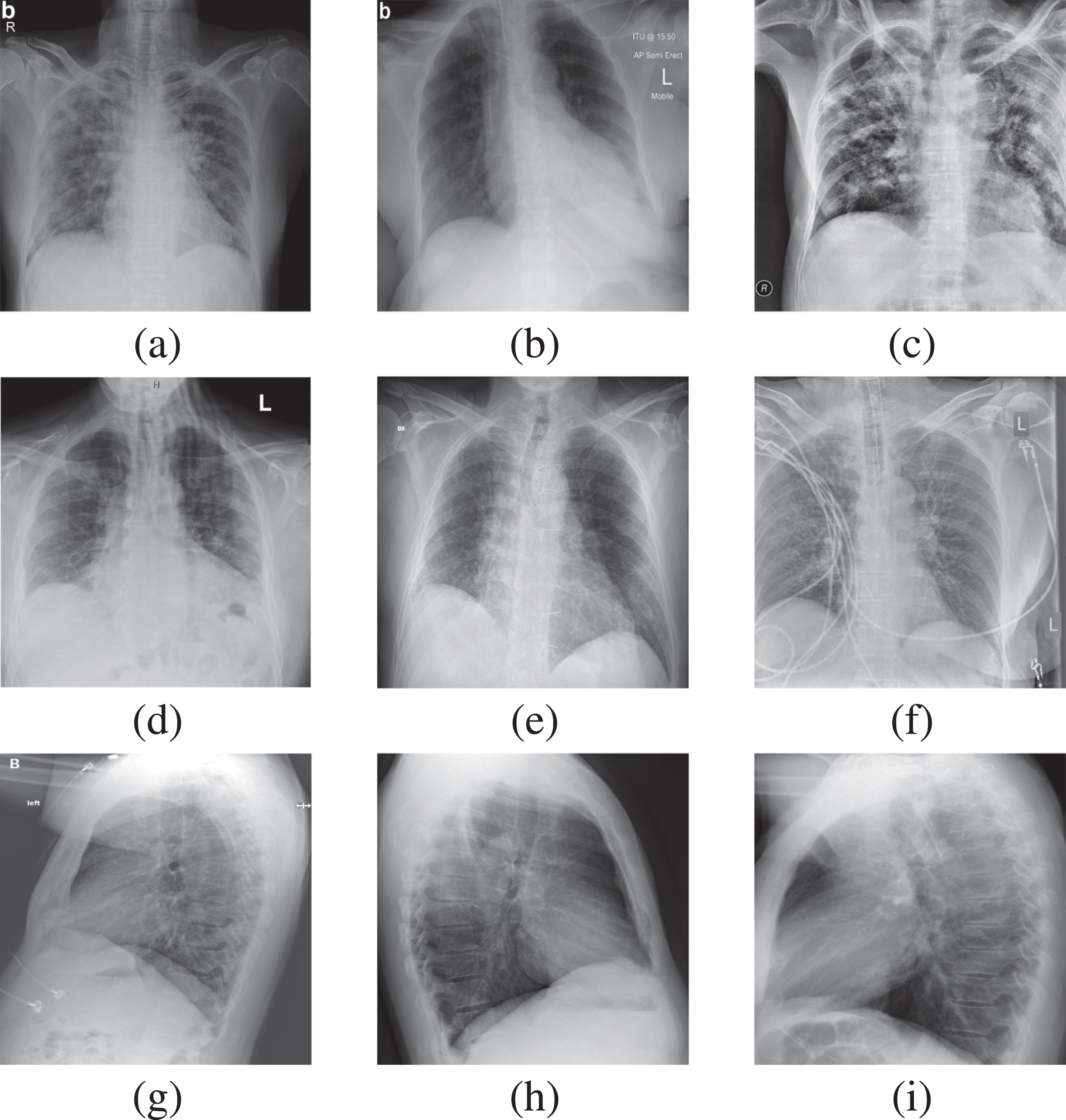 Thorax x-ray of COVID-19 Positive.