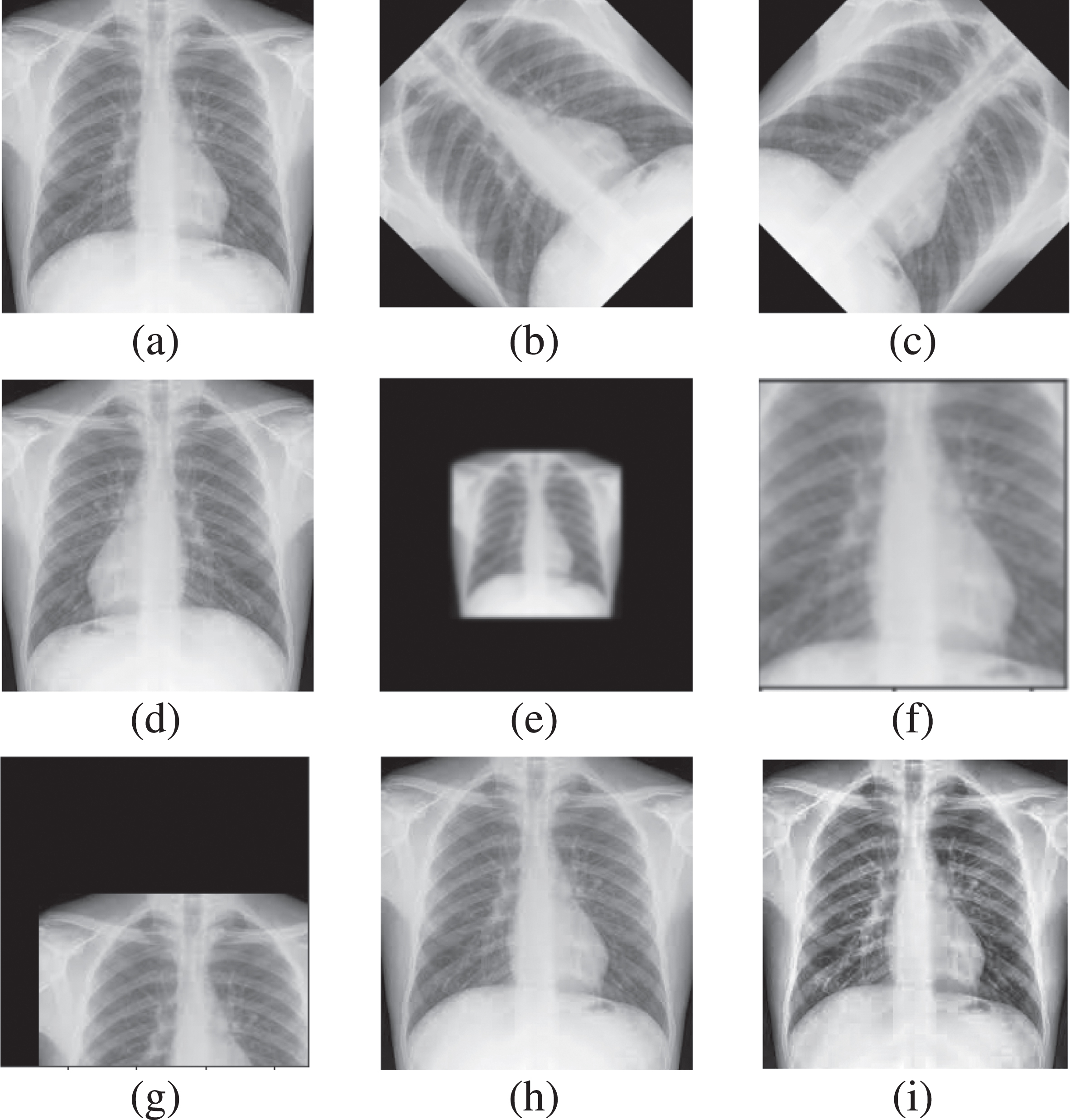 Data Augmentation (a)Original CXR (b)(c) Rotated (d) Horizontally Flipped (e) Zoomedout (f) Zoomedin (g) Shifted (h) Gaussian Noise (i) CLAHE enhanced.