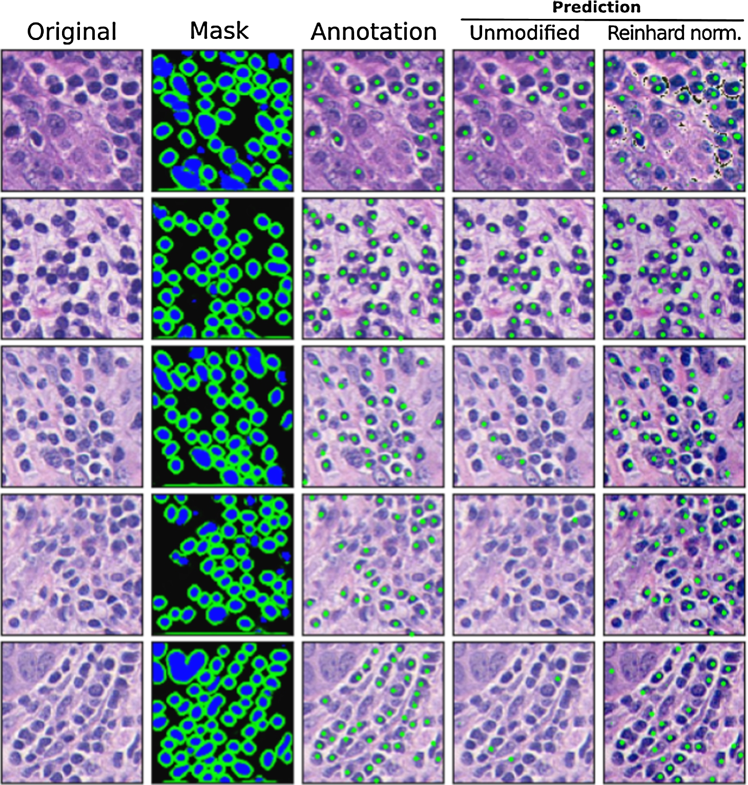 Exemplary 5 testing images from breast cancer lymphocyte dataset (Janowczyk and Madabhushi, 2016) with corresponding lymphocyte identification model outputs. From left to right: 1st column- original testing image from the lymphocyte dataset. 2nd column: nuclei segmentation masks predicted by autoencoder. 3rd column: Expert pathologist’s annotation supplied in the dataset. 4th column: lymphocyte classifier result (if the nucleus was predicted as a lymphocyte, its centre was labelled with a green dot). 5th column: lymphocyte classifier result after Reinhard stain normalization.