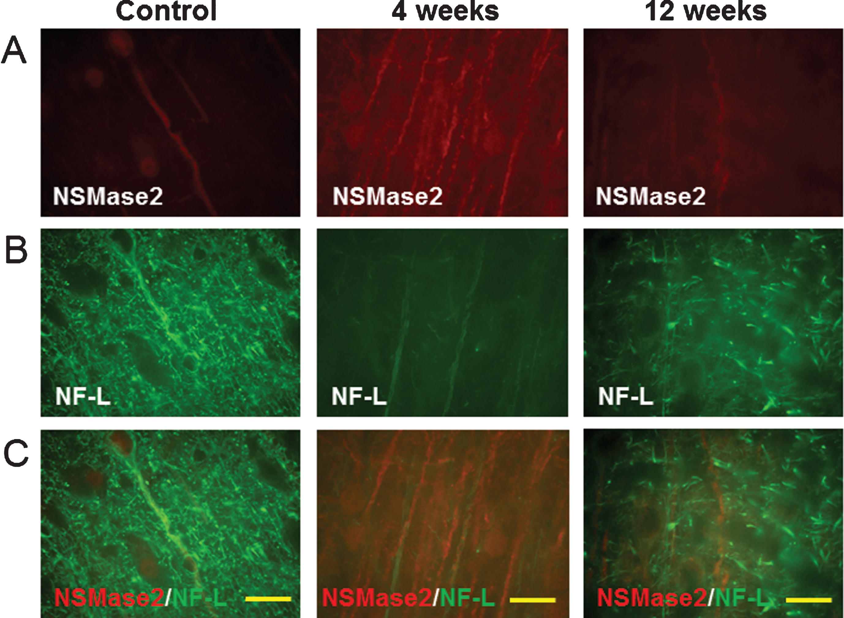 Localization of N-SMase2 in cortex of control rat and in rats 4 weeks and 12 weeks following LPS/IS/H. In control, N-SMase2 was localized to occasional cell bodies and to occasional axons, with N-SMase2 and neurofilament light chain protein (NF-L) co-localizing in these axons (N-SMase2/NF-L). At 4 weeks post LPS/IS/H, N-SMase2 was localized to large numbers of abnormal linear structures and some of these structures co-localized with NF-L (N-SMase2/NF-L). By 12 weeks post LPS/IS/H, N-SMase2 was again observed in a few scattered axons in cortex that co-localized with NF-L and appeared similar to controls. Bars = 50 μm.