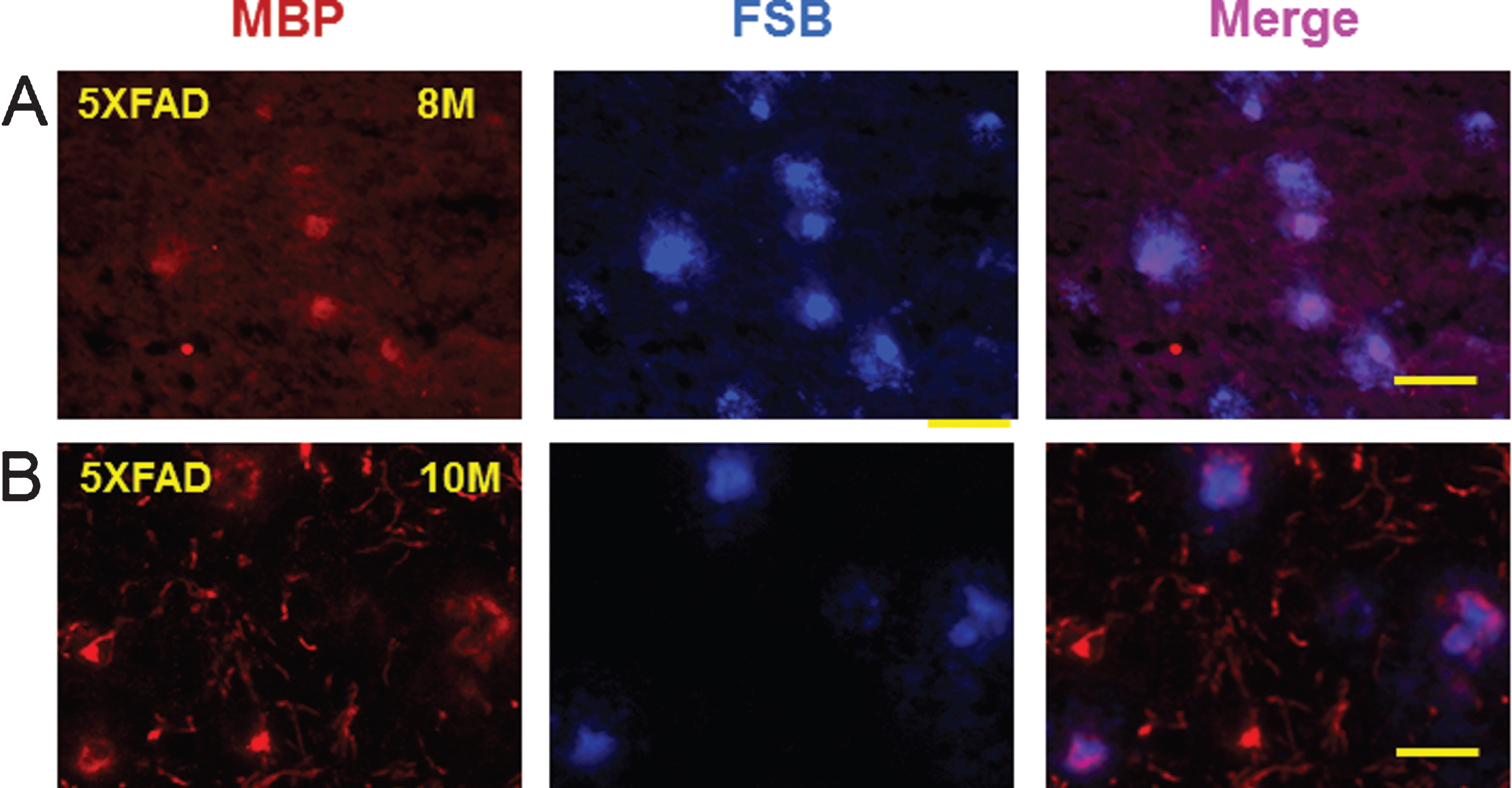 Double staining of myelin basic protein (MBP) and (E, E)-1-fluoro-2,5-bis (3-hydroxycarbonyl-4-hydroxy) styrylbenzene (FSB) in the amyloid plaques of 5XFAD mice. MBP positive myelin aggregates were detected in cortex of 8 month (8M, left panel) old (A) and 10 month (10M, left panel) old (b) 5XFAD mice. These MBP myelin aggregates co-localized (Merge) with FSB stained amyloid plaques in the cortex of 8 month old (8M, middle upper panel) and 10 month (10M, middle lower panel) old 5XFAD mice. MBP aggregates at 10 months (10M) seemed somewhat fragmented (B). The FSB stained plaques co-localized with MBP staining in 8M (upper right panel) and 10M (lower right panel) old animals (Merge). Bar = 50 μm.