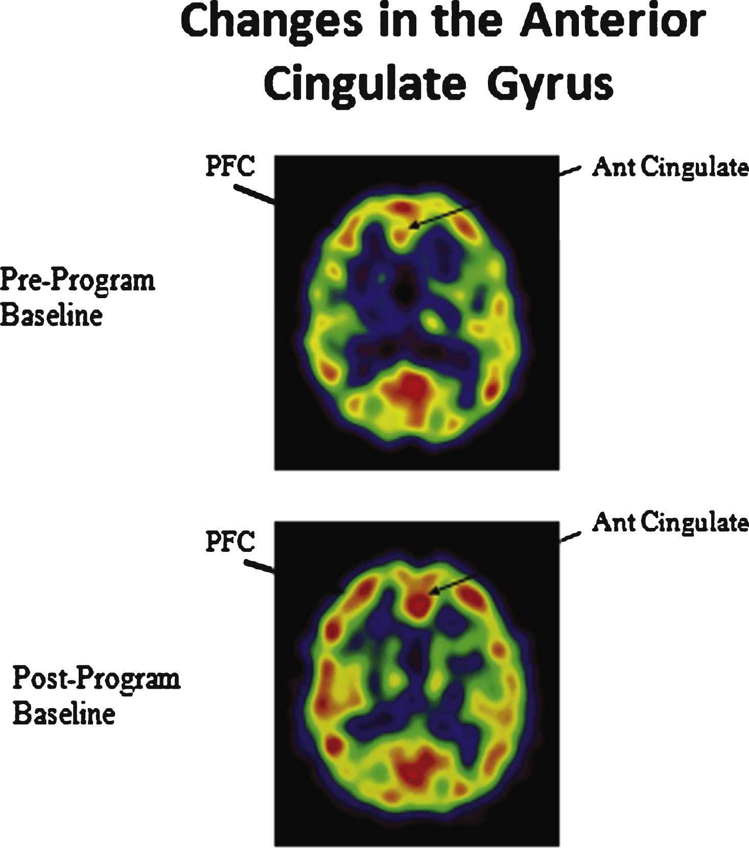 Enhanced cerebral blood flow in the prefrontal cortex (PFC) and anterior cingulate gyrus.