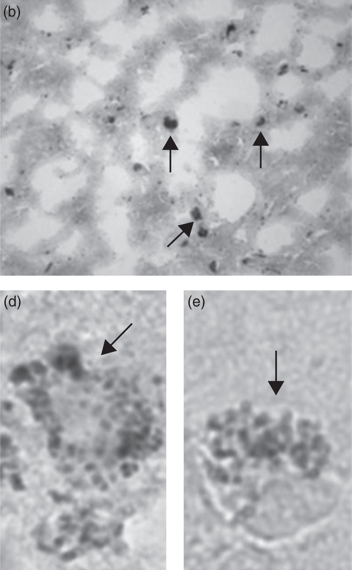 Images demonstrating Chlamydophila pneumoniae in AD brain tissue by in situ hybridization. Figure (b) demonstrates C. pneumoniae from the hippocampus of an AD brain by in situ hybridization. Figures (d) and (e) show photographic enlargement of cells harboring C. pneumoniae inclusions identified in AD brain tissue. Arrows indicate the signal for C. pneumoniae. Image (b) was obtained using a x40 objective. Figure from Gérard HC, Dreses-Werringloer U, Wildt KS, Deka S, Oszust C, Balin BJ, Frey WH 2nd, Bordayo EZ, Whittum Hudson JA, Hudson AP (2006) Chlamydophila (Chlamydia) pneumoniae in the Alzheimer’s brain. FEMS Immunol Med Microbiol 48, 355-366 [7]. Copyright 2006. Reprinted with permission from John Wiley and Sons and permission from Brian Balin.