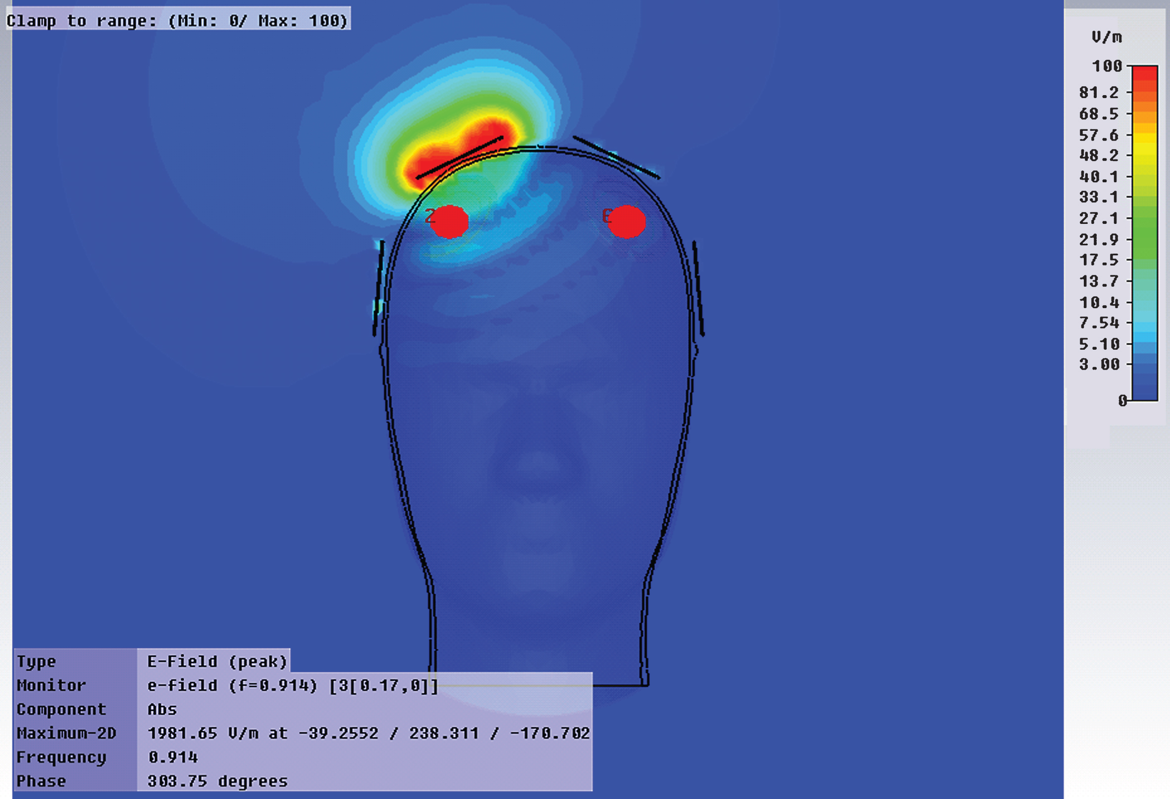 An FDTD computer simulation showing deep electric field penetration by an excitation element (one of eight elements) positioned on the cranium. Deep brain regions, such as the hippocampus and entorhinal cortex, are easily affected by this single element.