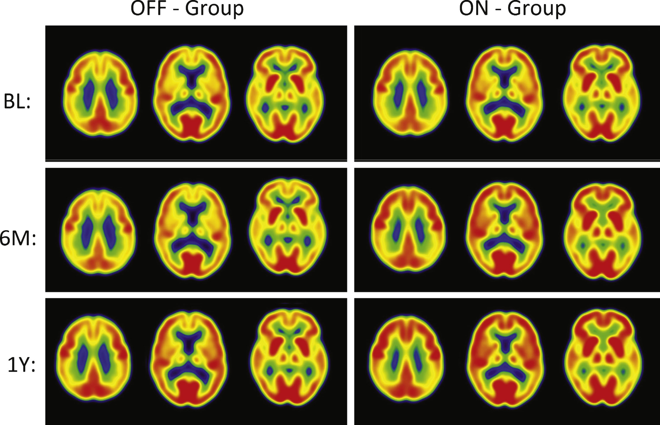 PET Cerebral glucose metabolism images by treatment groups. Summed Axial Images of standardized update values (SUV). BL, baseline, 6 months or 12 months after continuous bilateral deep brain stimulation (DBS) of the fornix. Representative axial sections show that patients in the “Off” group had stable or declining cortical glucose metabolism over time. In patients assigned to “On,” there were increases in brain metabolism at 6 months, particularly in the temporal and parietal regions, that were sustained at 12 months. The color scale indicates SUVs, with red showing highest, yellow and green intermediate and blue lowest. The patients remained on the same medications from baseline to 12 months while receiving DBS.