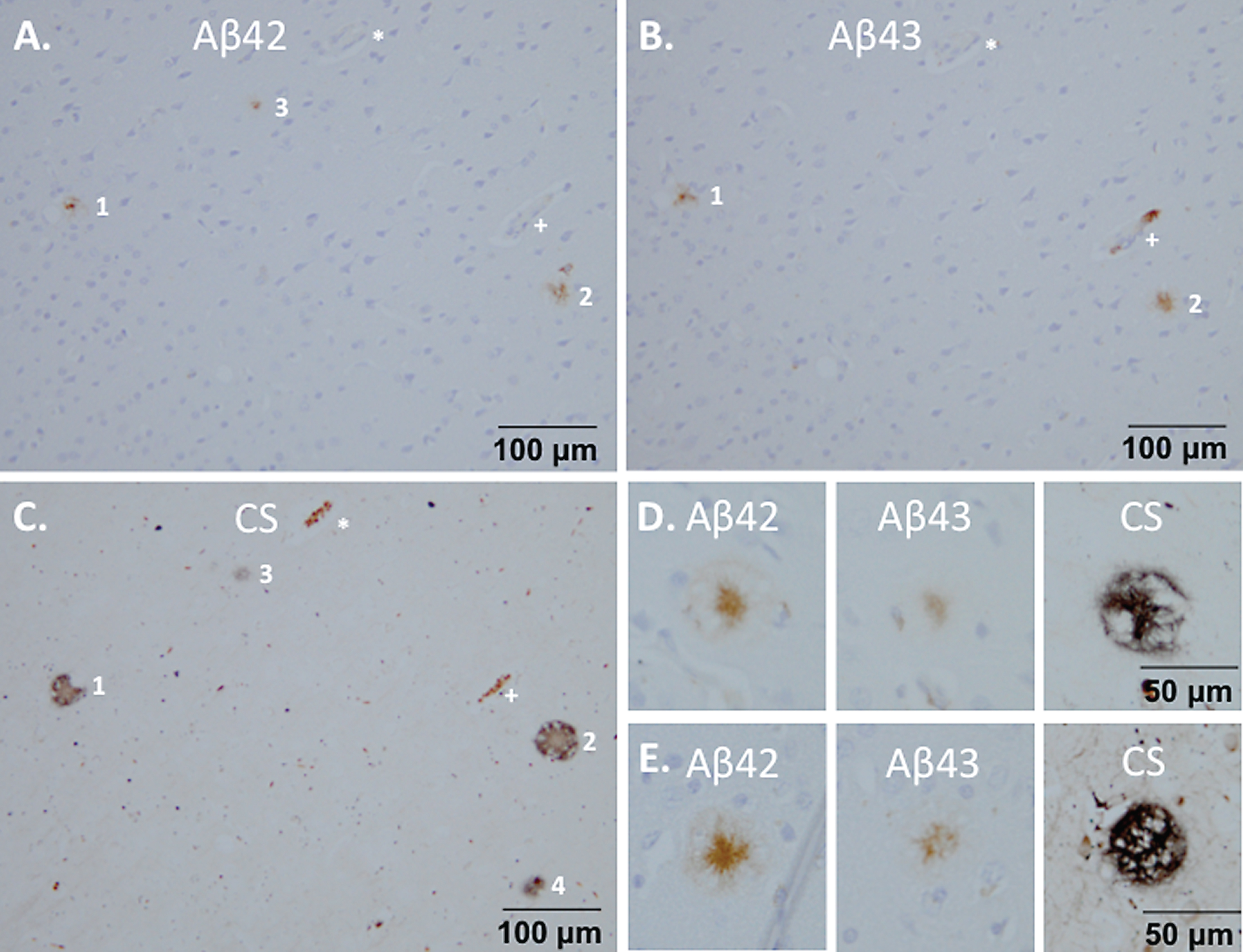 Composition of the plaques on brain sections from monkey m9856. Co-localization of Aβ42 (A) and Aβ43 (B) in plaques 1 and 2 are shown, which were also visible with the Campbell-Switzer staining (C). Plaque 3 was only Aβ42 positive and Campbell-Switzer positive. The vessels indicated by the asterisk (*) and plus (+) symbols, were used for navigation. Aβ42 mainly stained the center of the plaque, but also the outer circle, whereas Aβ43 only stains the center of the Campbell-Switzer positive plaque (D, E). CS, Campbell-Switzer staining; Aβ, amyloid-beta.