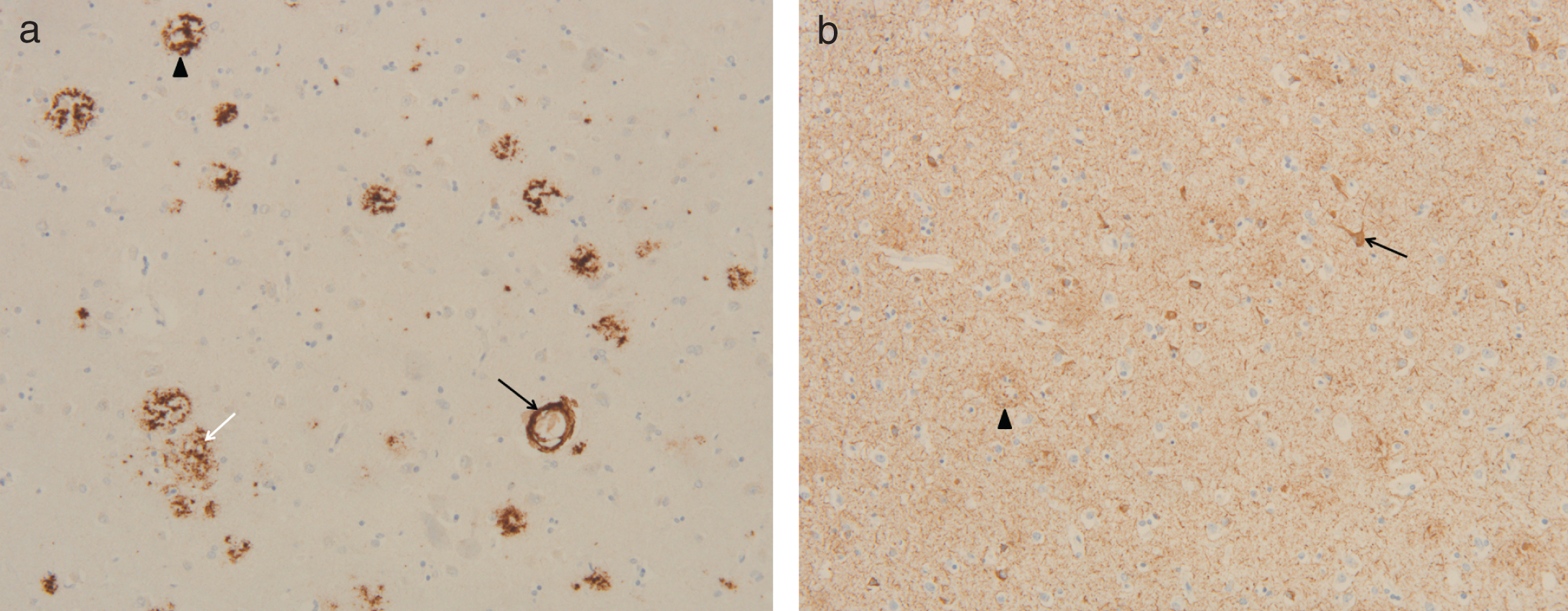 Immunohistochemistry in temporal cortex of subject II.4. a) Immunohistochemical staining for Aβ reveals cerebral Aβ angiopathy (black arrow), classical plaques (arrow head), and diffuse plaques (white arrow) in the temporal cortex (10x obj.); b) Immunohistochemical staining for tau (mab AT8) reveals neuropil threads, (pre)tangles (arrow), and neuritic plaques (arrow head) in the temporal cortex (10x obj.).