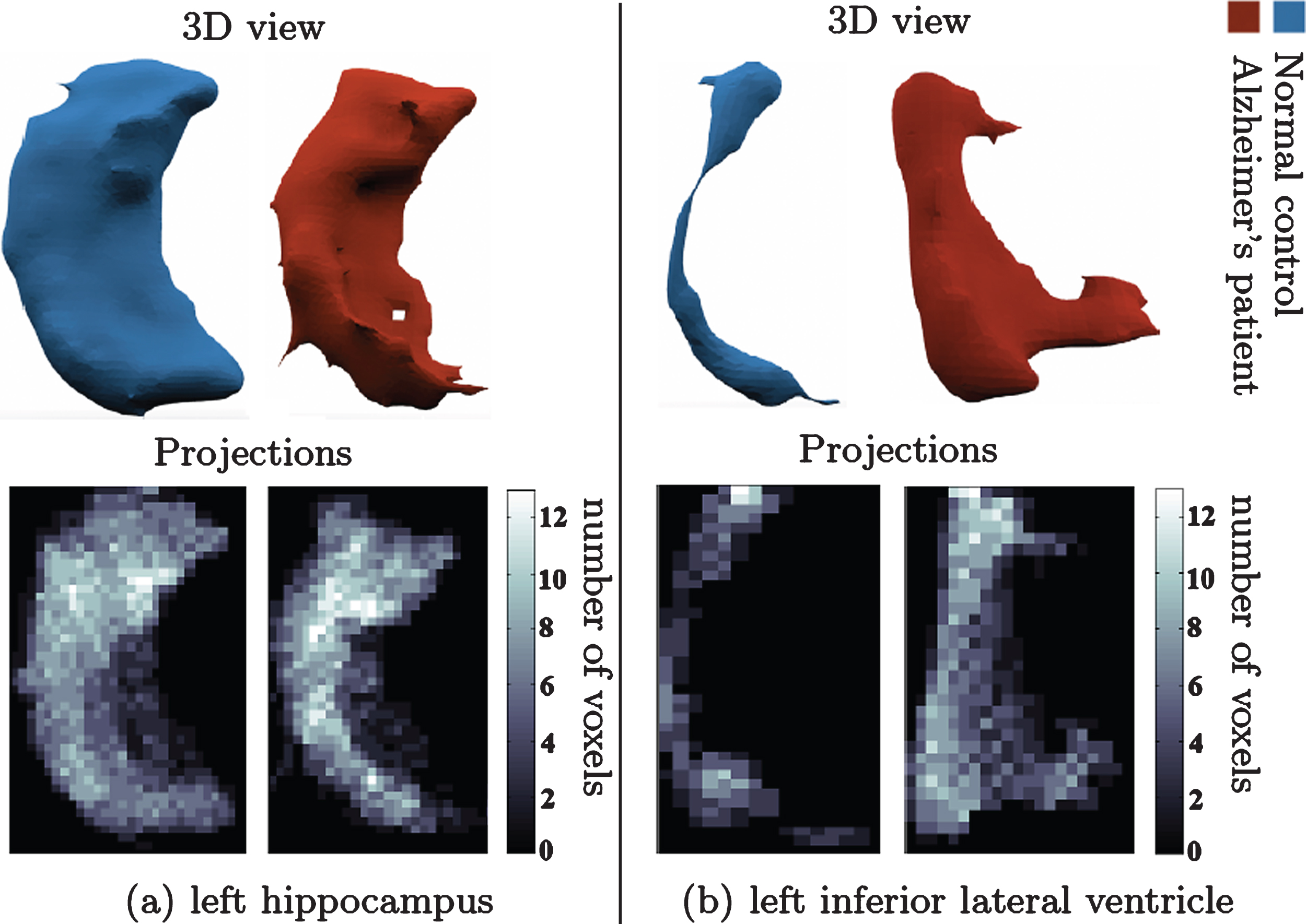 Change in shape of brain structures 
in AD manifested on projection images. (a) l. hippocampus 3D shape (upper panel) in NC (left) and AD (right). 
(b) l. inf. lat. ventricle 3D shape (upper panel) in healthy control (left) and AD patient (right). Lower panel 
shows the corresponding canonical view using our 
principal projections method.