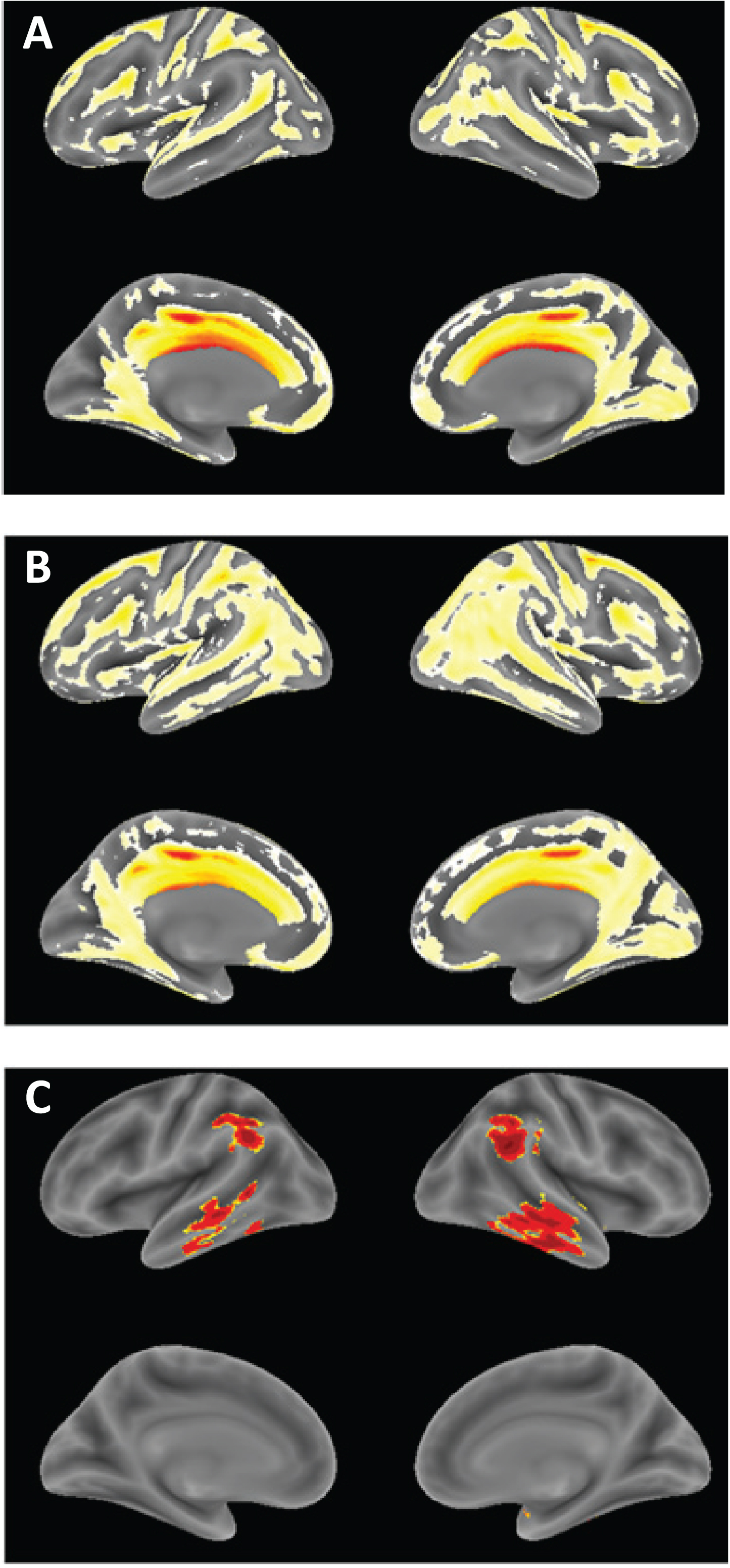Voxel-based morphometric comparison showing regions of greater atrophy in patients receiving LMTM as monotherapy [N = 157] (A) or as add-on to approved treatments for AD [N = 610], (B) in TRx-237-005 compared with elderly controls [N = 244] from the ongoing Aberdeen birth cohort studies [23, 26], controlled for age, sex and total intracranial volume of each individual. (C) Voxel-based morphometric comparison of monotherapy and add-on patients in TRx-237-005. Data are displayed at a significance threshold corrected for family-wise error at the whole brain level at p < 0.05.
