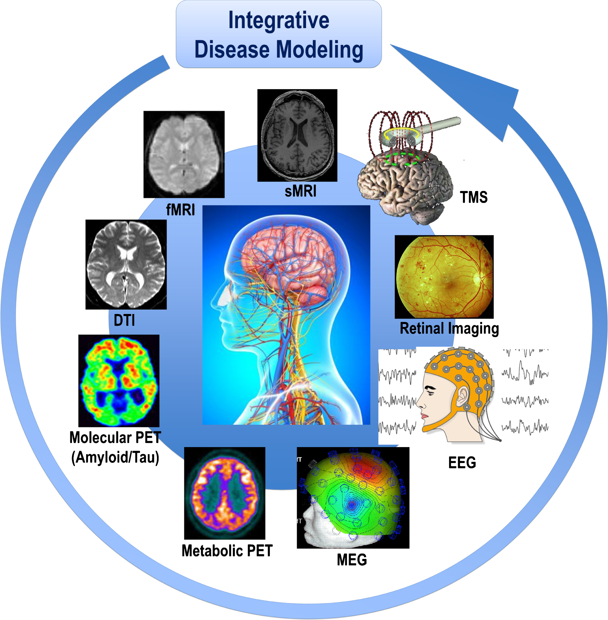 Cohorts stratified according to different neuroimaging modalities and methods are integrated in the disease modeling for classification and prediction of subsets of AD and other ND patients. The paradigm of systems neurophysiology aims at studying the fundamental principles of integrated neural systems functioning by integrating and analyzing neural information recorded in multimodal fashion through computational modeling and combining data-mining methods. This paradigm may be used to decode the information contained in experimentally-recorded neural activity using analysis methods that are able to integrate the recordings of simultaneous, single-modality brain cell activity such as fMRI or EEG to generate synergistic insight and possibly infer hidden neurophysiological variables. The ultimate goal of systems neurophysiology is to clarify how signals are represented within neocortical networks and the specific roles played by the multitude of different neuronal components. AD, Alzheimer’s disease; DTI, diffusion tensor imaging; EEG, electroencephalography; MEG, magnetoencephalography; fMRI, functional magnetic resonance imaging, sMRI, structural magnetic resonance imaging; ND, neurodegenerative diseases; PET, positron emission tomography; TMS, transcranial magnetic stimulation