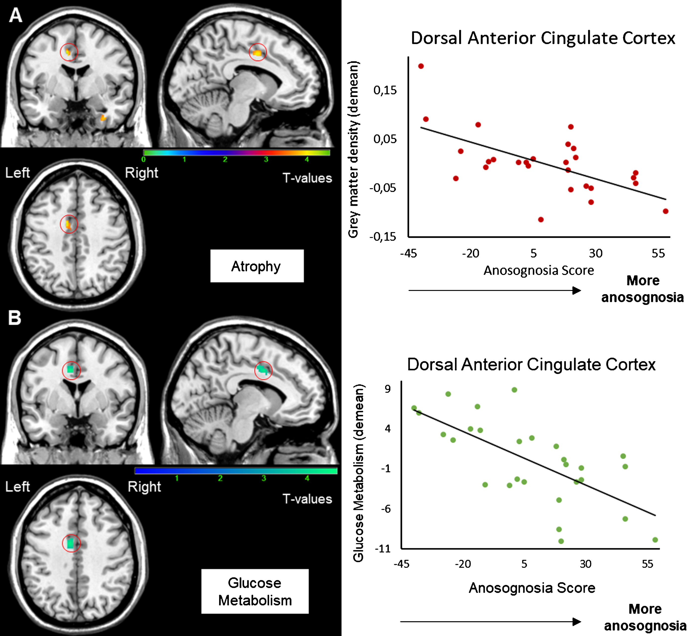 Correlation between the anosognosia score and MRI (A) and FDG-PET scans (B). Results were obtained from 27 T1-3D scans (A) and 28 FDG-PET scans (B) in Alzheimer’s disease patients. The statistical threshold is puncorr <0.001 (k > 70 voxels). Correlations are performed on the whole cluster after extraction of data with MARSBAR.