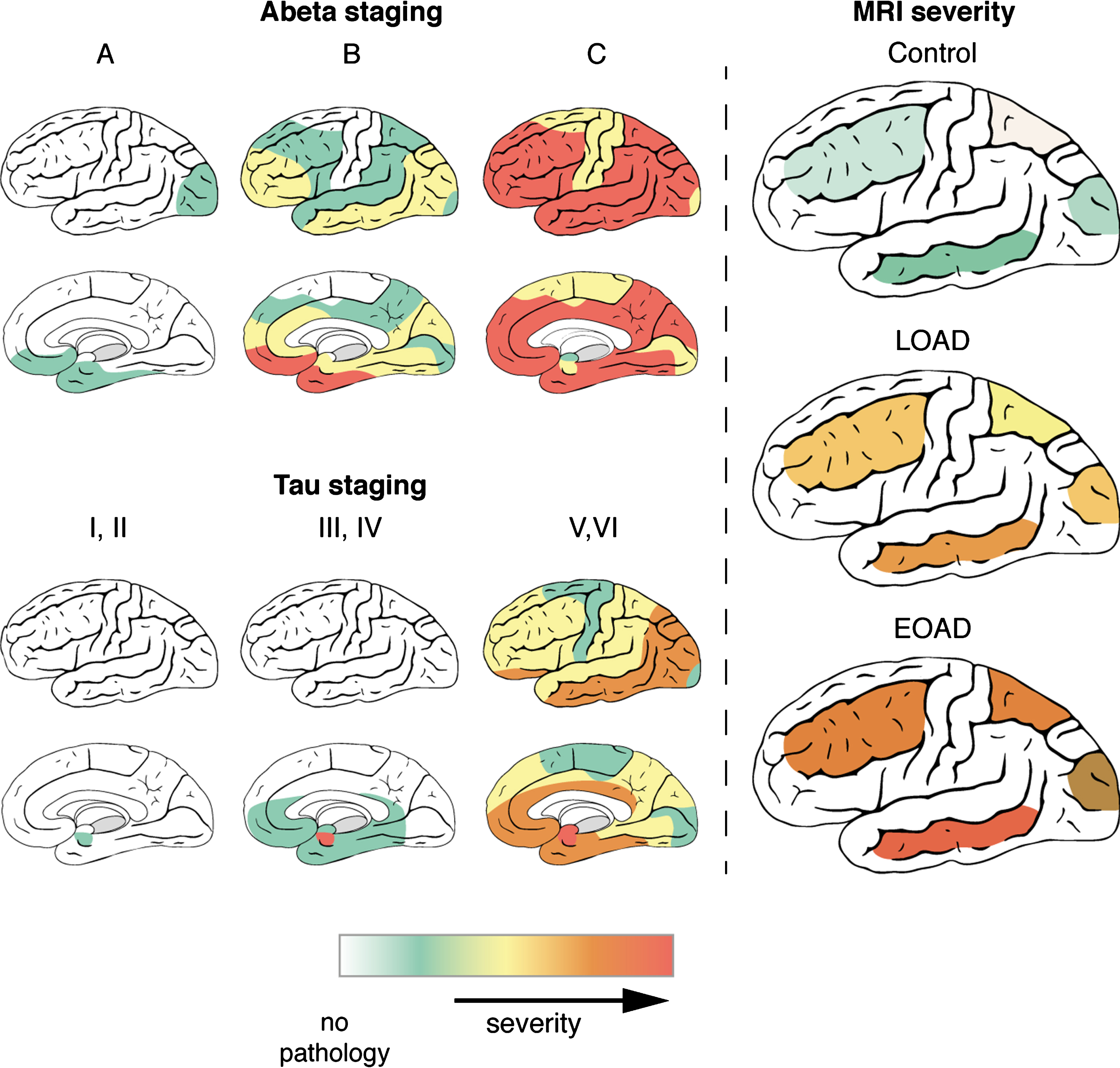 Distribution of AD pathology and MRI contrast changes over the cortex. During disease progression, both AD pathological hallmarks spread throughout the brain in characteristic patterns, which are not the same for Aβ and tau. As described previously, Aβ plaques are first found in the basal parts of the frontal, occipital, and temporal lobe and gradually spread throughout the whole cortex. In later stages, Aβ plaques are also found in allocortical regions, the striatum, brainstem nuclei and eventually in the cerebellum. In contrast to Aβ plaques, tau tangles are first detected in the transentorhinal region of the middle temporal lobe. Subsequently, the basal parts of the frontal and temporal lobe are affected and finally the entire cortex, including the striatal cortex. In the histologically determined stages of AD pathology as well as the MRI contrast changes, the temporal lobe is the most affected region corresponding to the distribution pattern of tau pathology. Even in controls, which have only limited tau pathology and MRI contrast changes, the temporal lobe is most affected. Severity scales ranges for Aβ and tau staging from no pathology (white) to severe pathology (red). For MRI, MRI severity scores were calculated for specific cortical regions based on presence of a diffuse hypointense band (Methods). MRI severity scales ranges from severity not determined (white) to severe MRI changes (red).