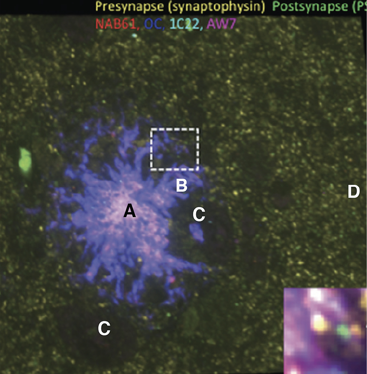 Array tomography staining of brain tissue showing the presence of Aβ (red, deep blue, light blue, purple antibody stains) and pre- (yellow) and postsynaptic densities (green). Letters have been added to identify regions discussed in the text. Reprinted from Pickett EK et al., Non-fibrillar oligomeric amyloid-β within synapses, J Alzheimers Dis 53, 787–800, 2016, and modified with permission from authors and IOS Press.