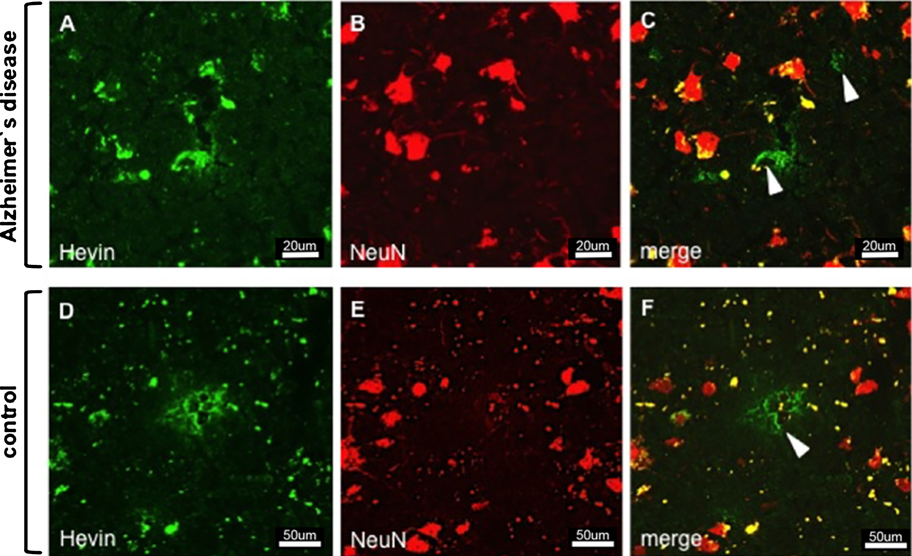 Immunostaining of Hevin and neurons in AD (images A–C) and control tissue (images D–F). Despite the proposal that Hevin is expressed by neurons, all of the images show cell types (arrowheads) other than neurons.
