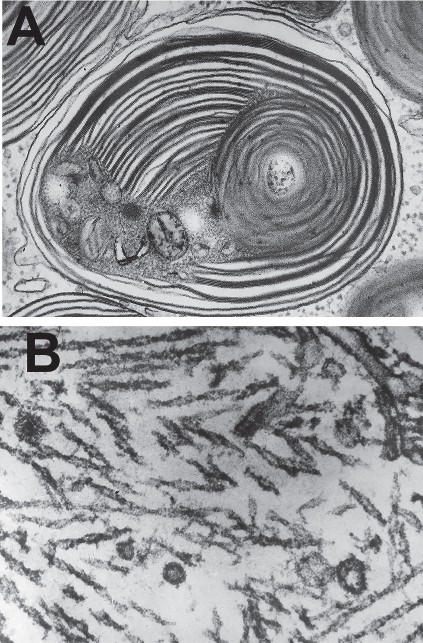 Bob Terry’s classical electron micrographs of (A) an abnormal lysosome in Tay Sachs Disease and (B) paired helical filaments in the neurofibrillary tangles in Alzheimer’s disease.