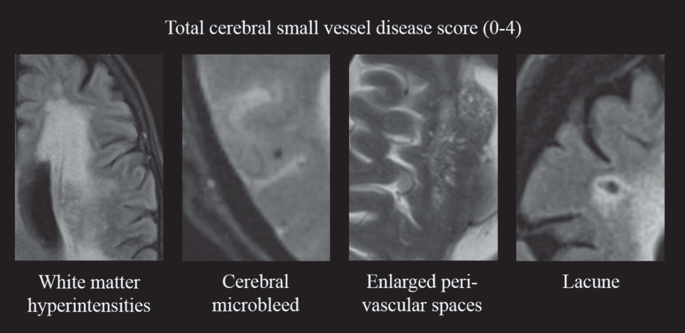 Construction of the total cerebral small vessel disease score. One point is added to the score in case of presence of: severe WMH (periventricular Fazekas grade 3 or deep Fazekas grade ≥2); ≥1 cerebral microbleed; >10 perivascular spaces visible in the basal ganglia on at least one side of the brain; ≥1 lacune. WMH, white matter hyperintensities.