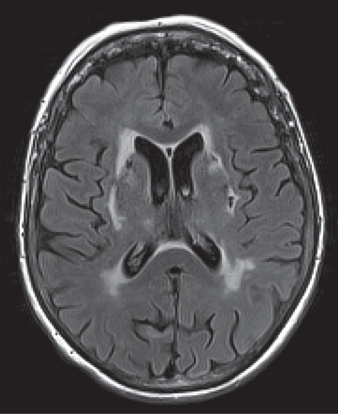 MR FLAIR image of patient with basal ganglia infarcts.