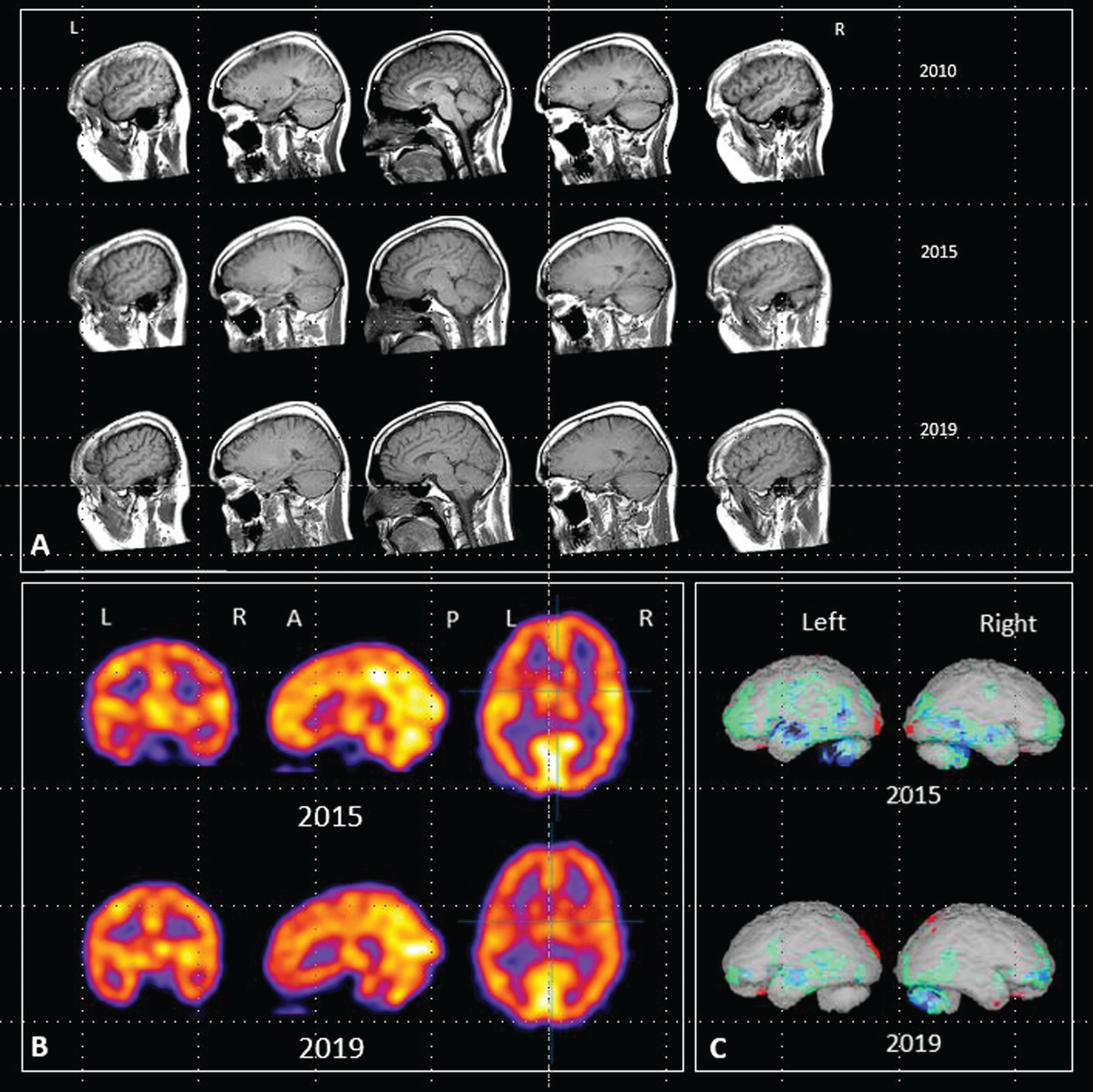 A) Sagittal MRI images acquired in 2010, 2015 and 2019. B) HMPAO-SPECT scan images acquired in 2015 and 2019. C) Rendered images using NeuroGamTM (http://www.segamicorp.com) outputs showing Z scores from the normal range of a control group aged 16 to 45 years with data normalized to cerebellum. Green represents >2 standard deviations below the mean, light blue > 3, dark blue > 4, black > 5. Red represents greater than 2 standard deviations above the mean.