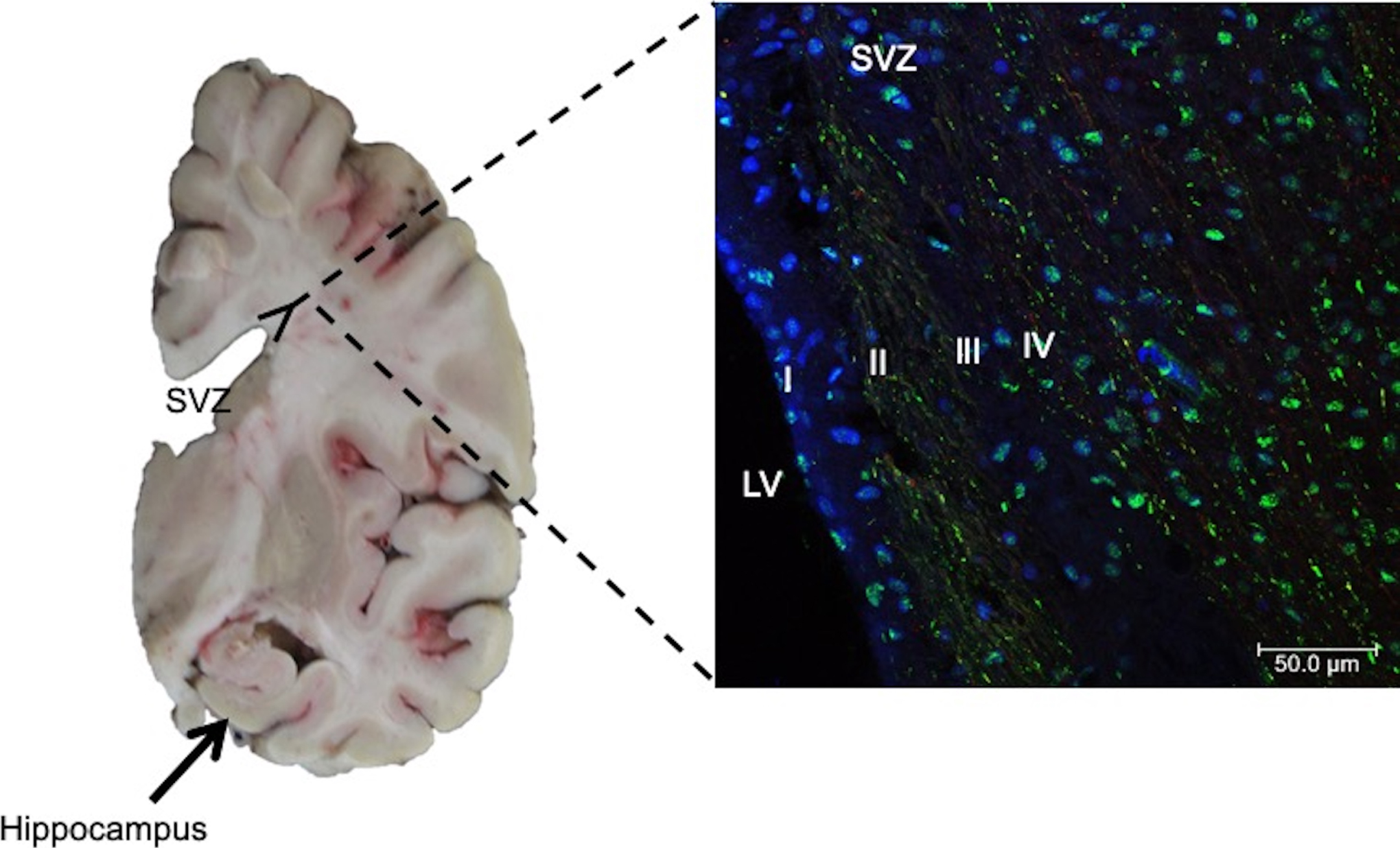 Left. Coronal section of human brain. Neural stem cells in the subgranular zone of the hippocampal dentate gyrus (arrows) and subventricular zone (SVZ), lining the walls of the lateral ventricles (LV), have been reported. Right. Immunofluorescent staining of SVZ in AD brain. Antibody against phospho-tau protein and counterstaining with To-Pro Iodide was used to reveal nuclei. Four layers in the SVZ are observed: I) ependymal layer, II) hypocellular gap, III) astrocytic ribbon layer, and IV) transitional zone. Staining for phospho-tau protein showed dense labeling of speckles associated with nuclei.