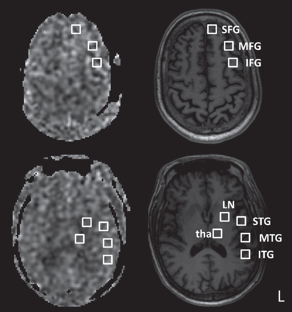 Example regions of interest in the left hemisphere. Cerebral blood flow maps (left column) and corresponding T1-weighted images (right column) are shown for two axial slices. SFG, superior frontal gyrus; MFG, middle frontal gyrus; IFG, inferior frontal gyrus; STG, superior temporal gyrus; MTG, middle temporal gyrus; ITG, inferior temporal gyrus; LN, lentiform nucleus; tha, thalamus. The regions of interest are of equal size.