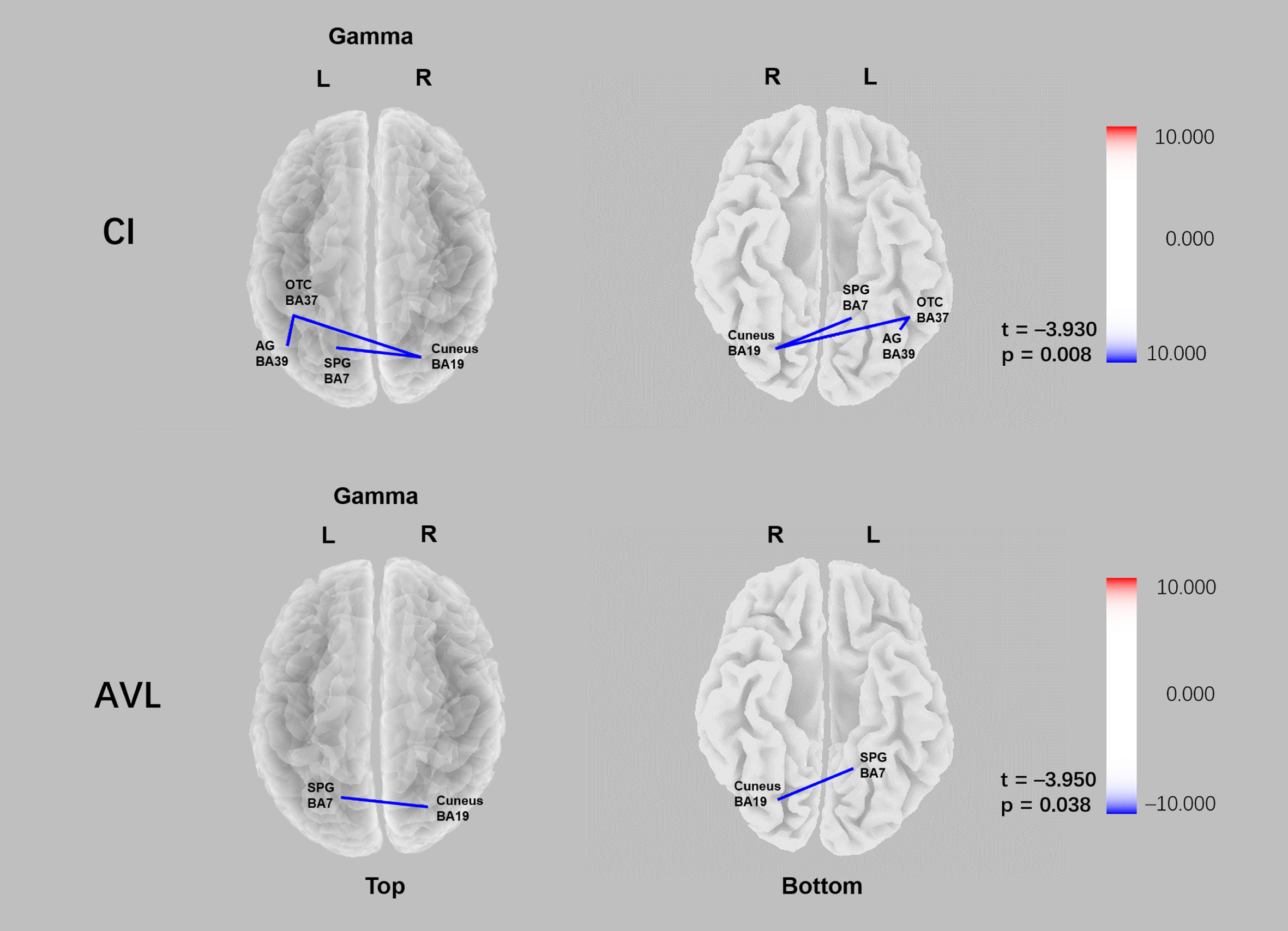 Comparison of functional connectivity of the CI and AVL groups relative to HC group in sLORETA source space. Lower gamma linear connectivity between the right cuneus (BA19) and the left superior parietal gyrus (BA7) was observed in both CI group and AVL groups relative to the HC group (pCI = 0.008; pAVL = 0.038).