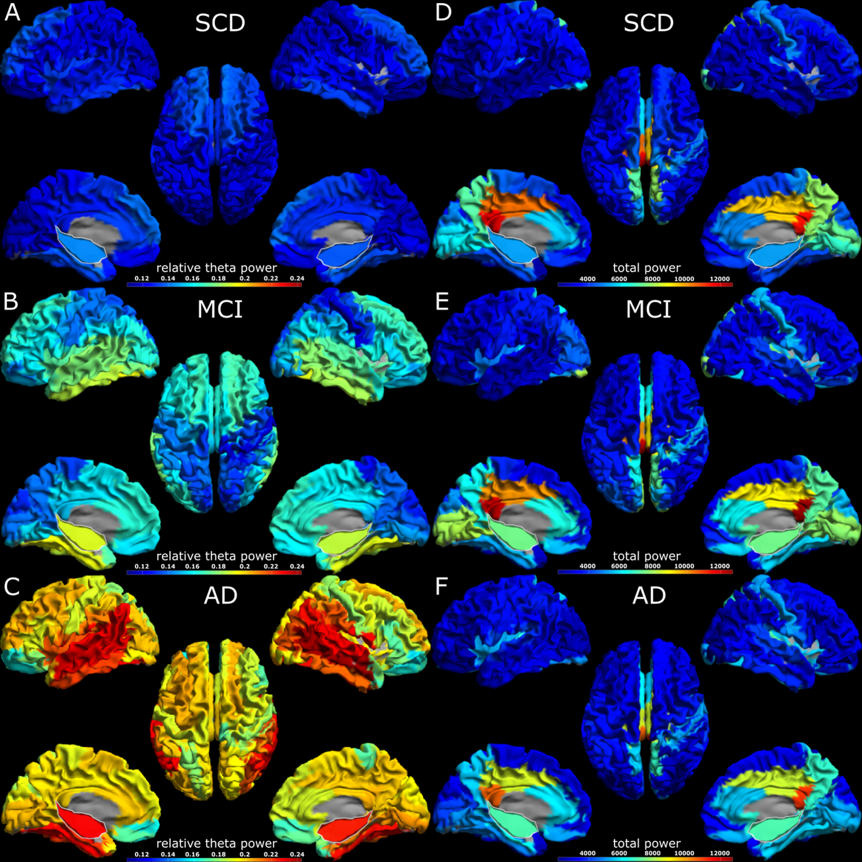 3D headplots of spectral analysis results across groups. The hippocampus has been projected on the medial surface and is outlined in white. Panels A-C display relative theta power, while panels D-F display total power results. The virtual electrodes were scaled by a factor of one hundred when converting from *.fif to *.asc format. SCD, subjective cognitive decline; MCI, mild cognitive impairment; AD, Alzheimer’s disease.