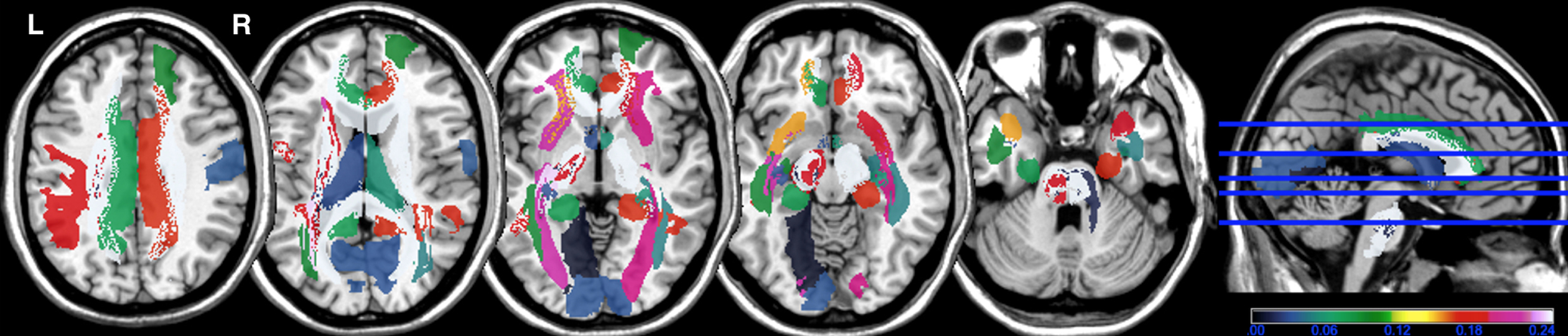 Frequency map of white matter hyperintensities in each structure. Color bar: frequency (higher number corresponds to higher frequency) of white matter hyperintensities in each structure of the Automatic Anatomical Labelling (AAL) and NatbrainLab (CAT) atlases. (e.g., tracts in white color correspond to the presence of WMH in 25% of patients). R, right; L, left.