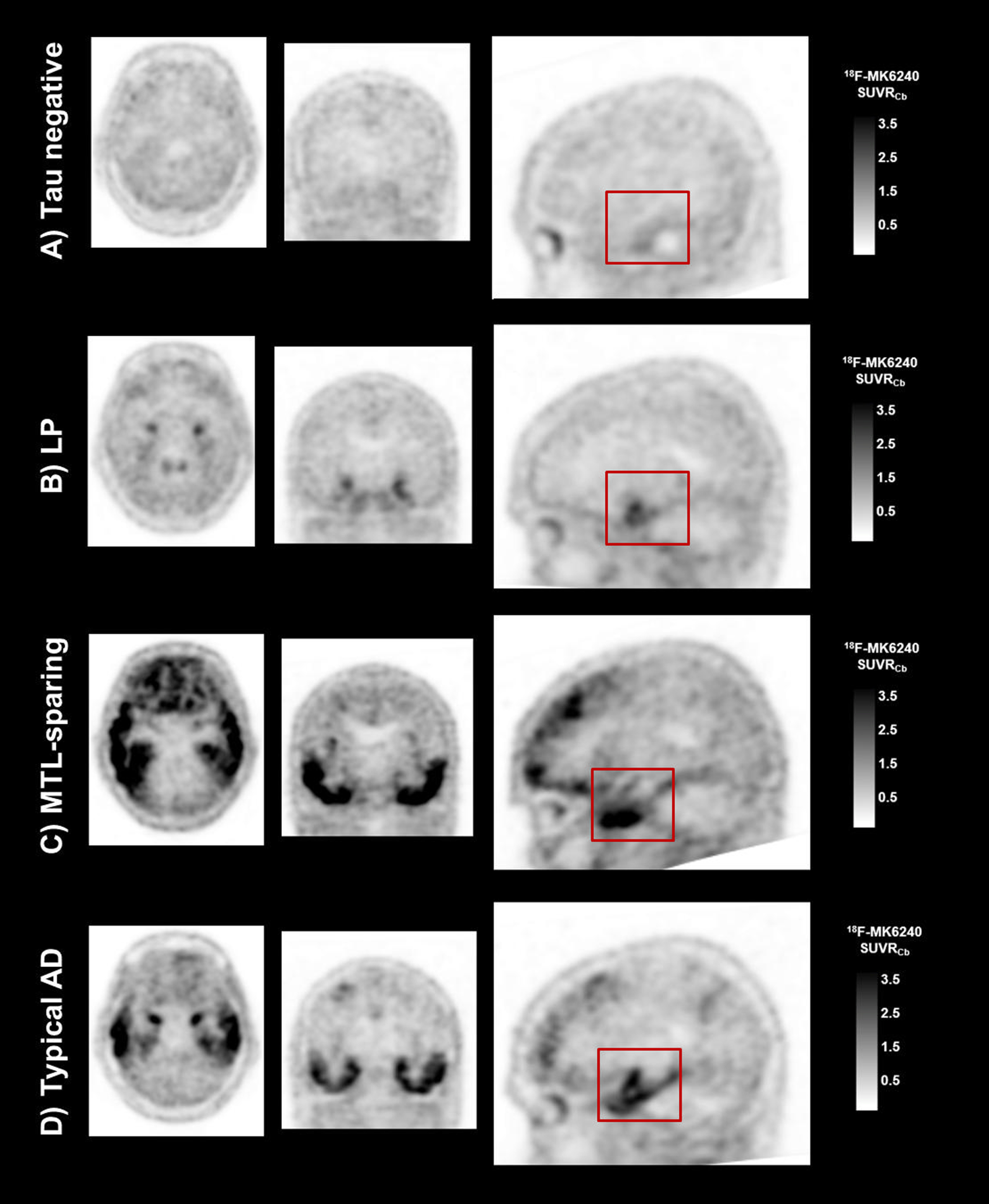 Examples of the four tau 18F-MK6240 PET visual classification categories. Representative tau 18F-MK6240 PET SUVR images for participants classified as A) tau negative; B) LP predominant; C) MTL-sparing; and D) Typical. The red boxes highlight 18F-MK6240 tracer retention in a “hook”-like distribution, observed in the LP and Typical cases, and the relative absence of 18F-MK6240 tracer retention in these structures in the MTL-sparing case, where instead tracer retention is observed in the inferior temporal lobe.