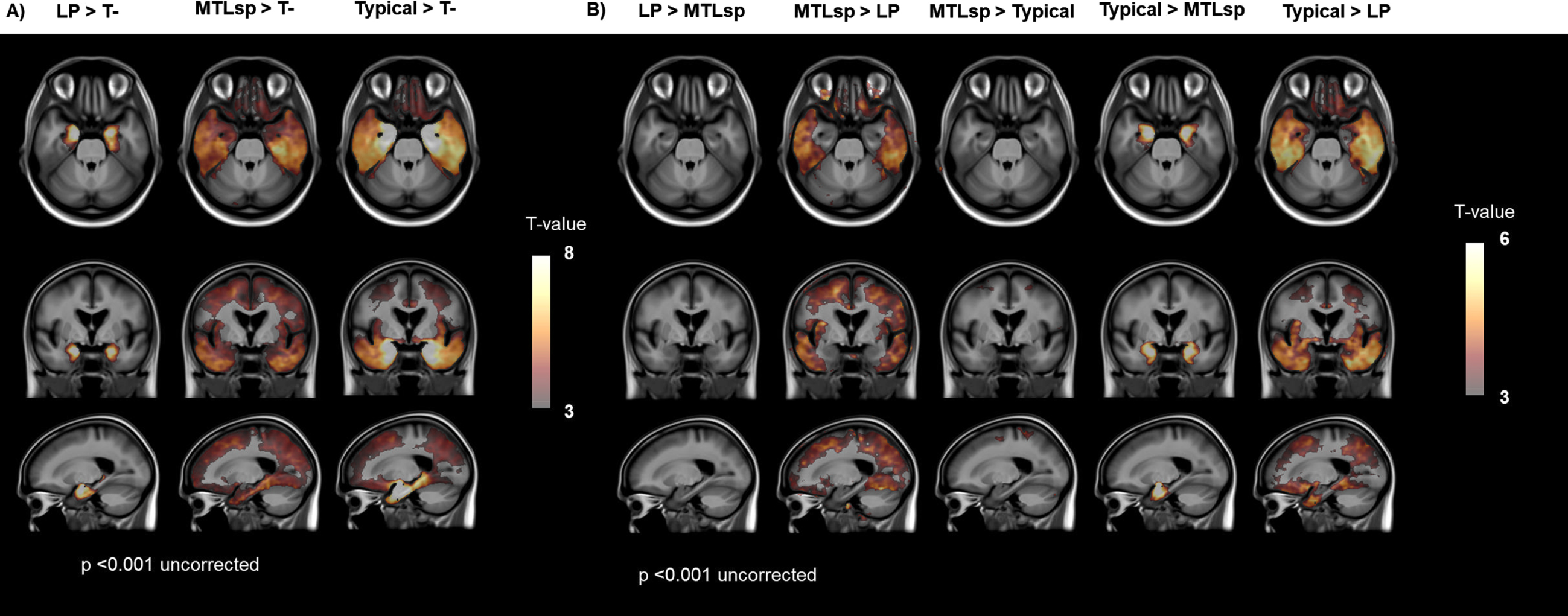 Voxel-wise comparisons between visually classified groups. Voxel-wise contrasts between visually classified groups overlaid on a T1 MRI template with a threshold of significance of p < 0.001 (uncorrected for multiple comparisons). T-, tau negative; LP, limbic predominant; MTLsp, mesial temporal lobe sparing.